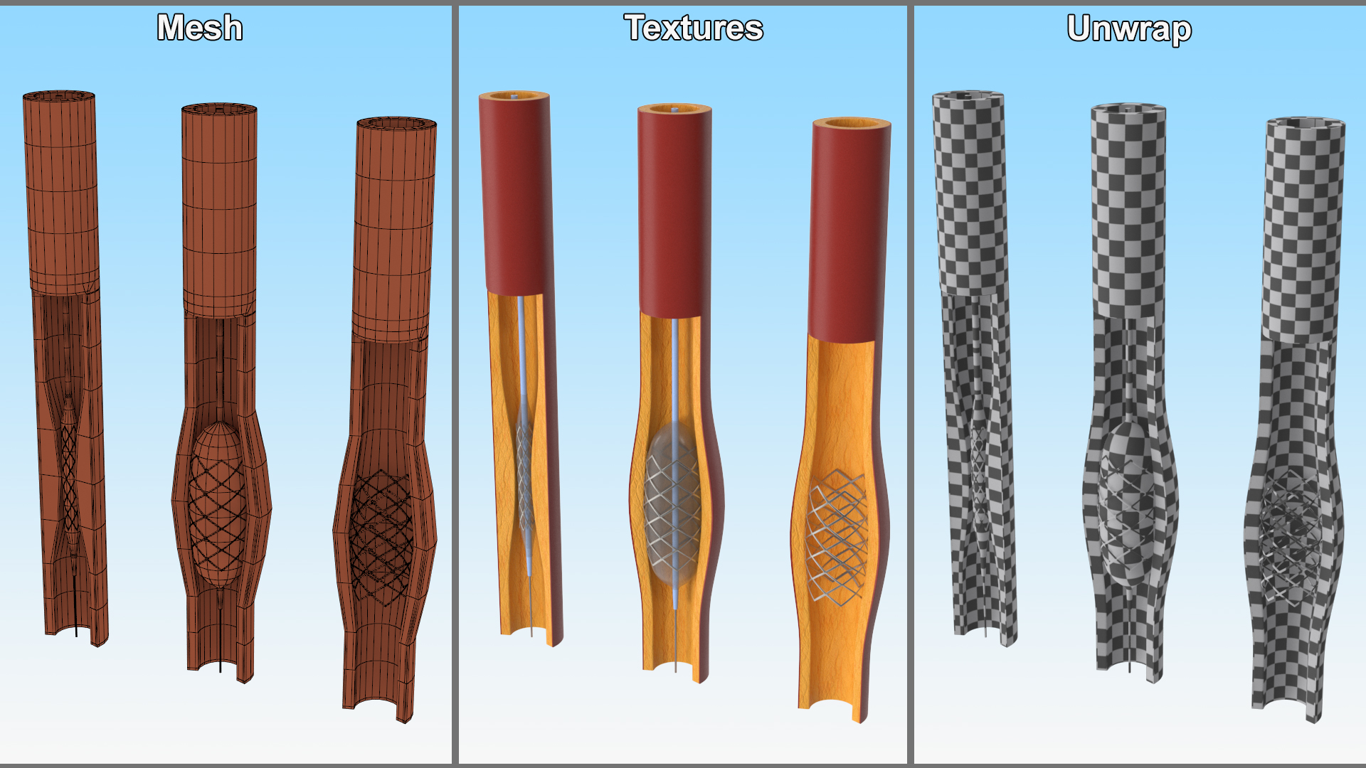 3D Plastic Models of Stents with Artery