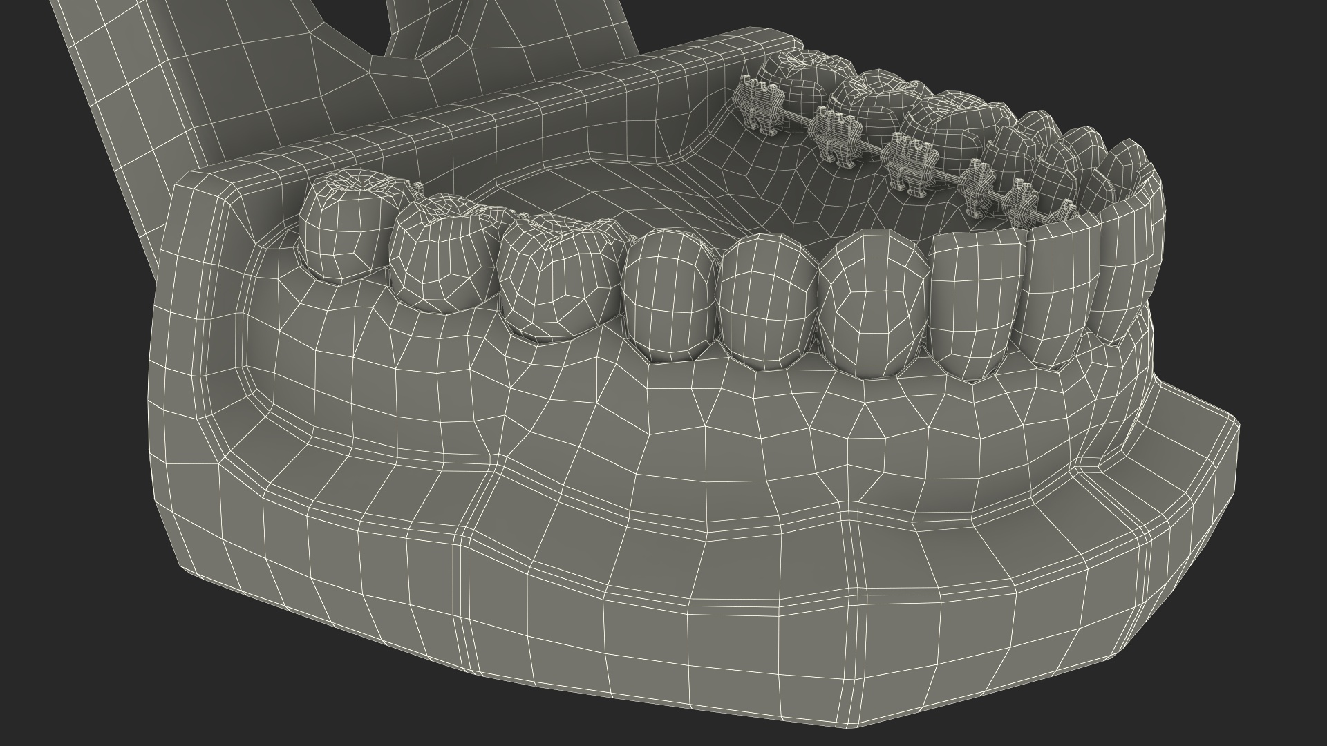 3D Lingual Braces on Typodont Teeth Model model