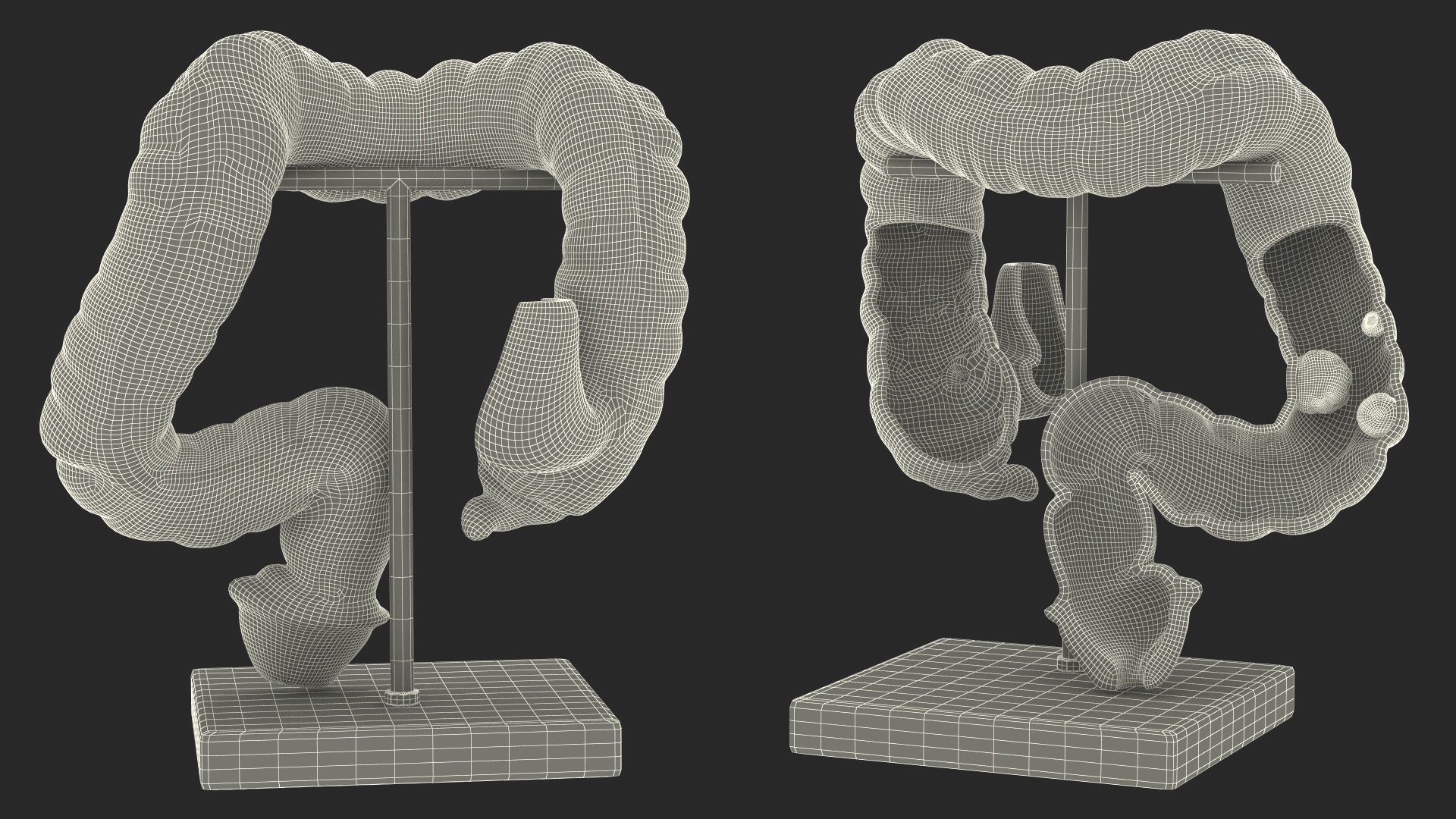 Medical Model Diseased Intestine 3D