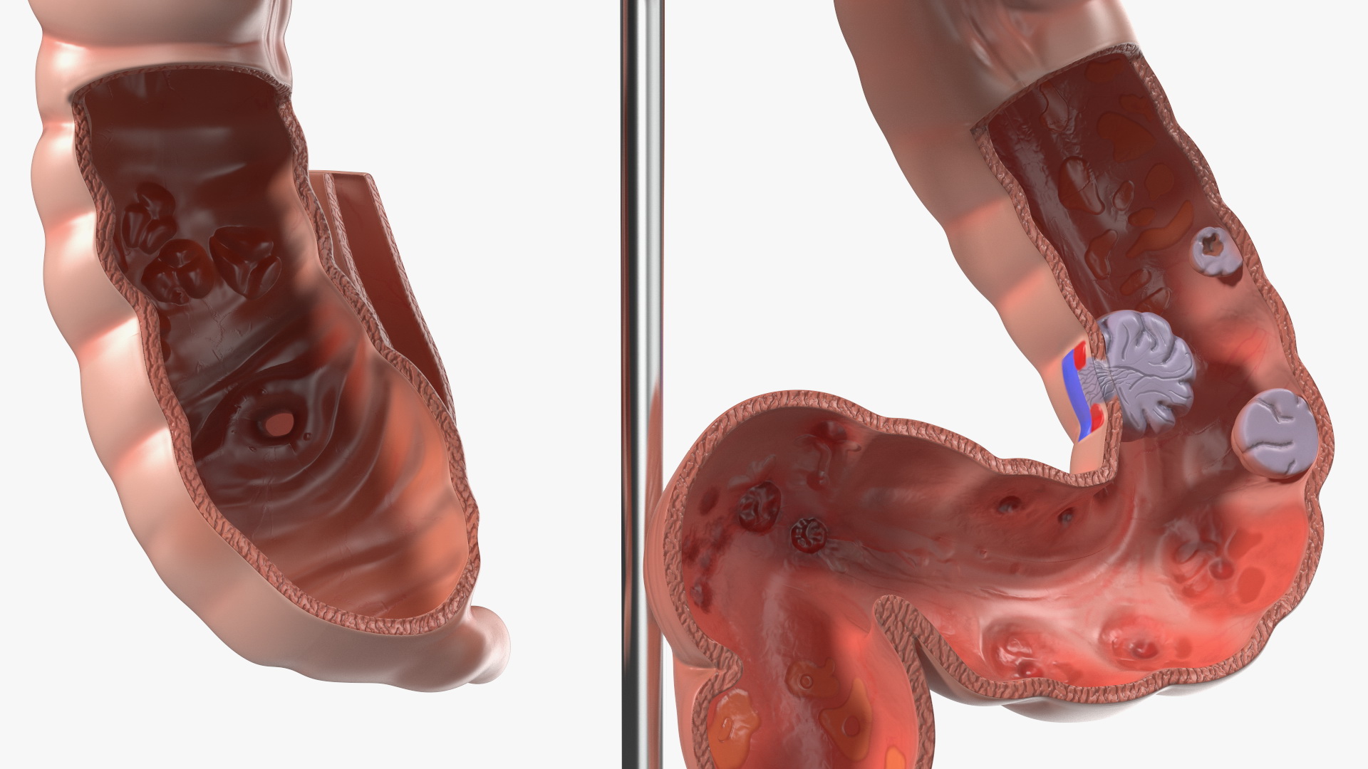 Medical Model Diseased Intestine 3D