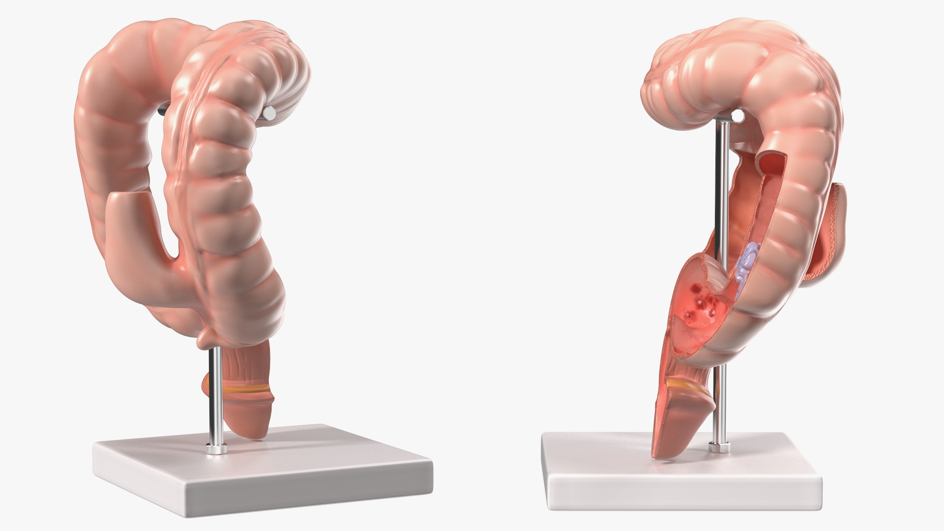 Medical Model Diseased Intestine 3D