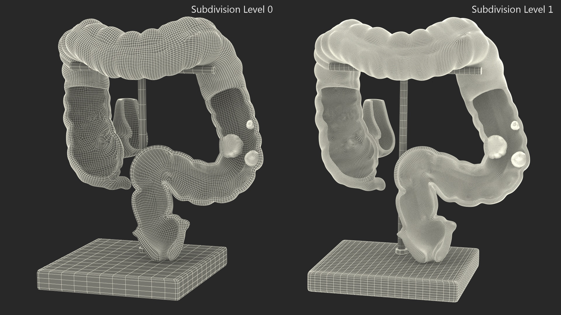 Medical Model Diseased Intestine 3D