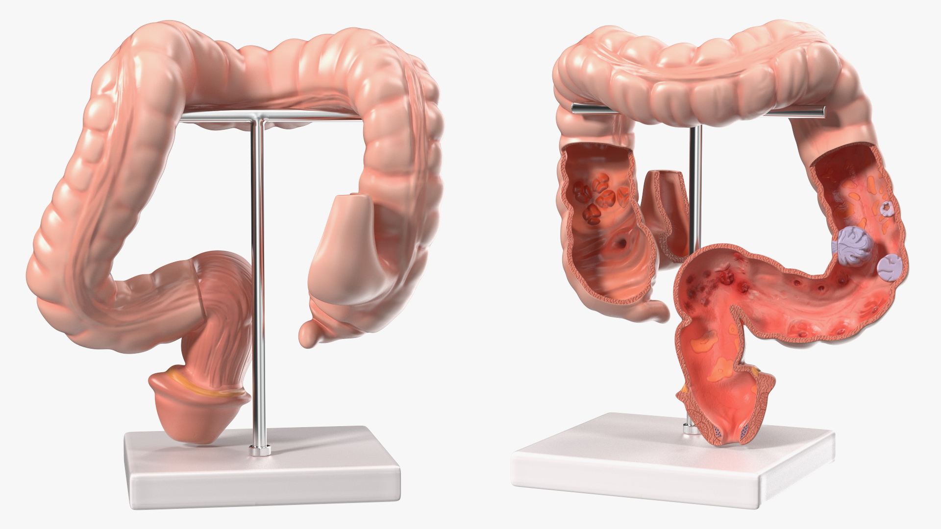 Medical Model Diseased Intestine 3D