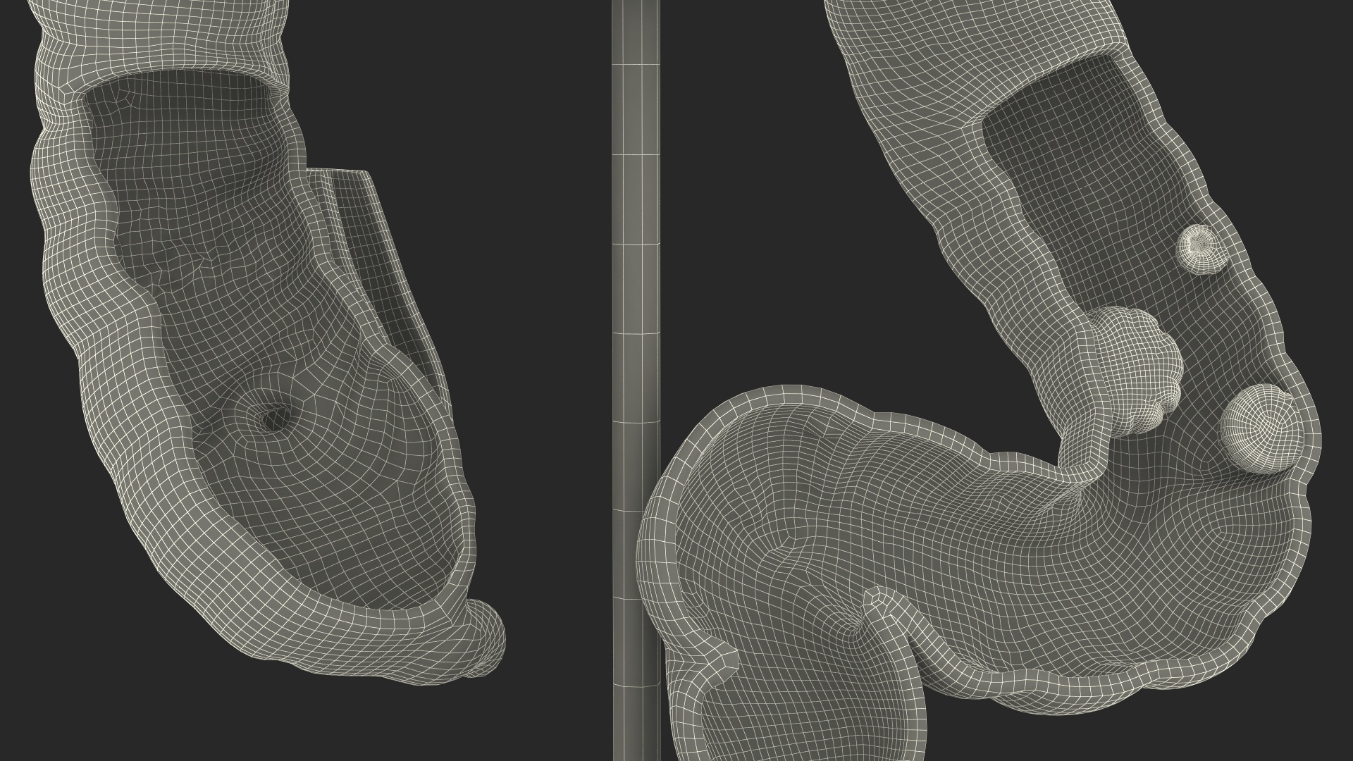 Medical Model Diseased Intestine 3D