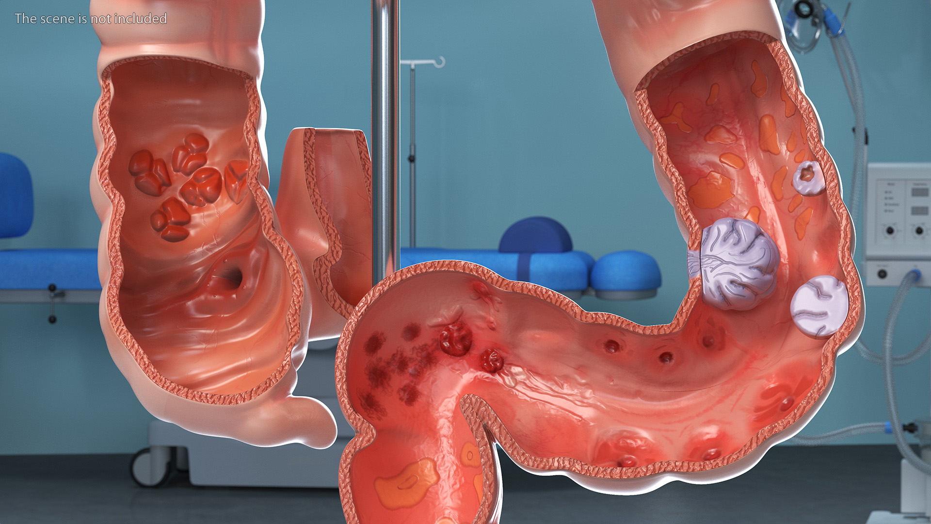 Medical Model Diseased Intestine 3D