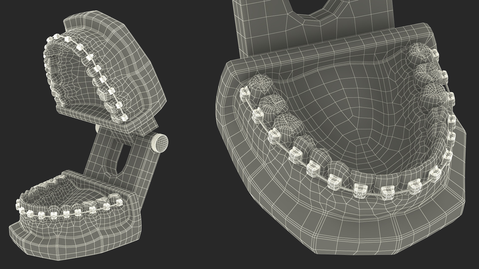 3D Ligature-Free Braces on Artificial Jaw model