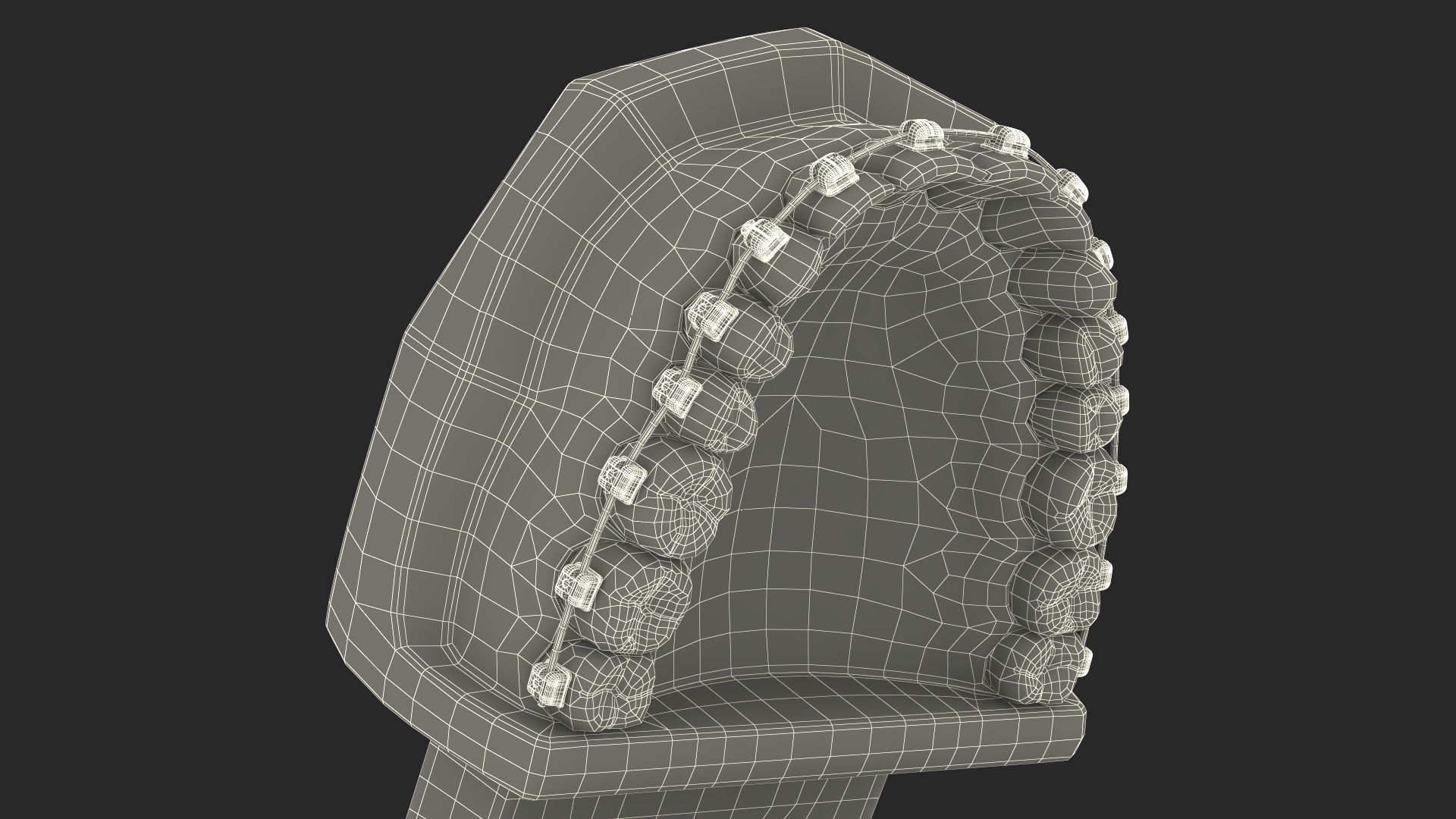 3D Ligature-Free Braces on Artificial Jaw model