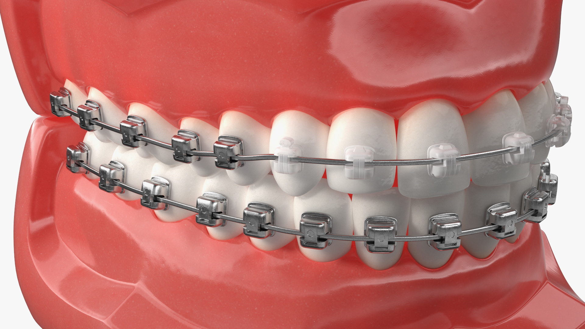 3D Ligature-Free Braces on Artificial Jaw model