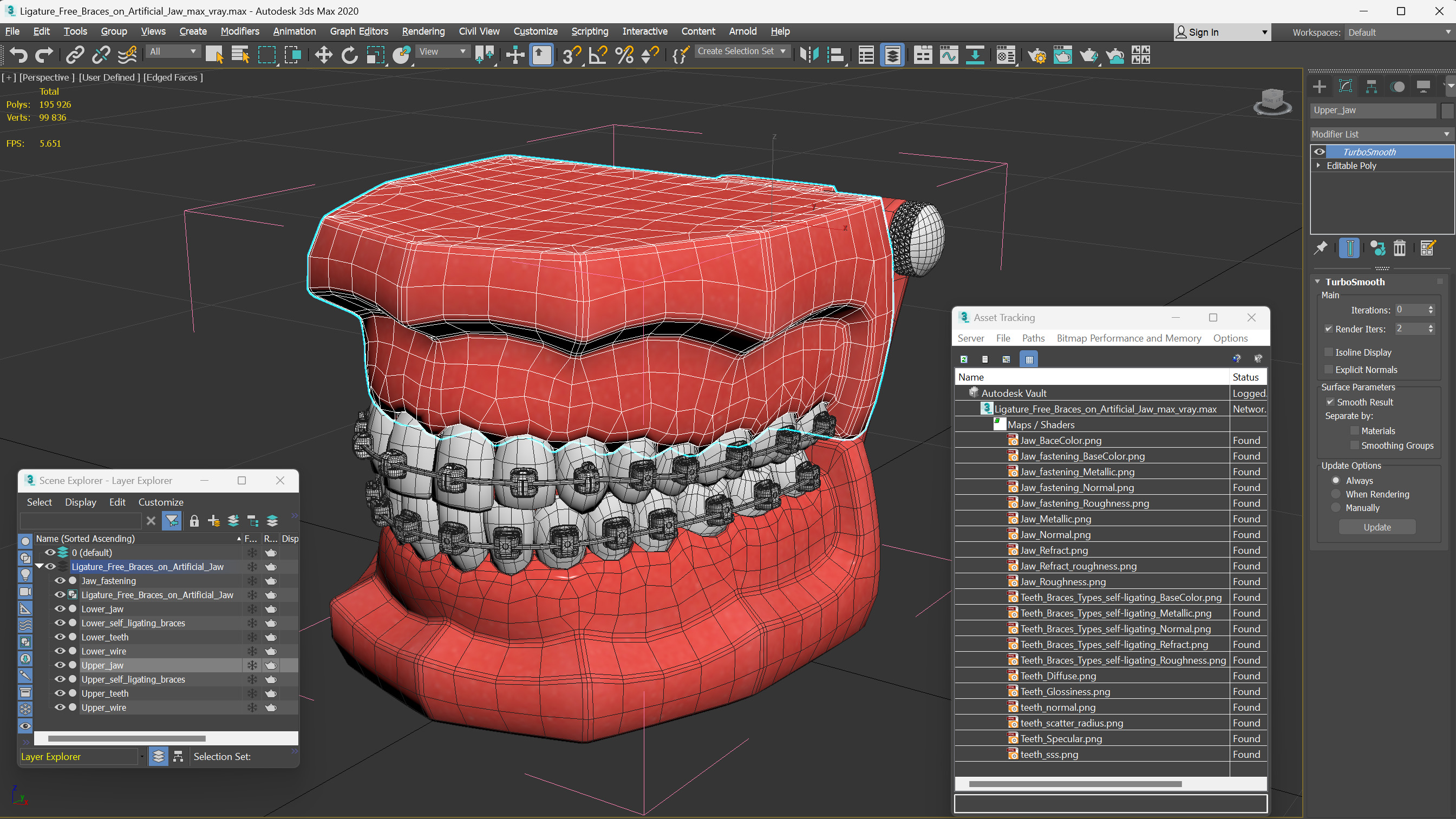 3D Ligature-Free Braces on Artificial Jaw model