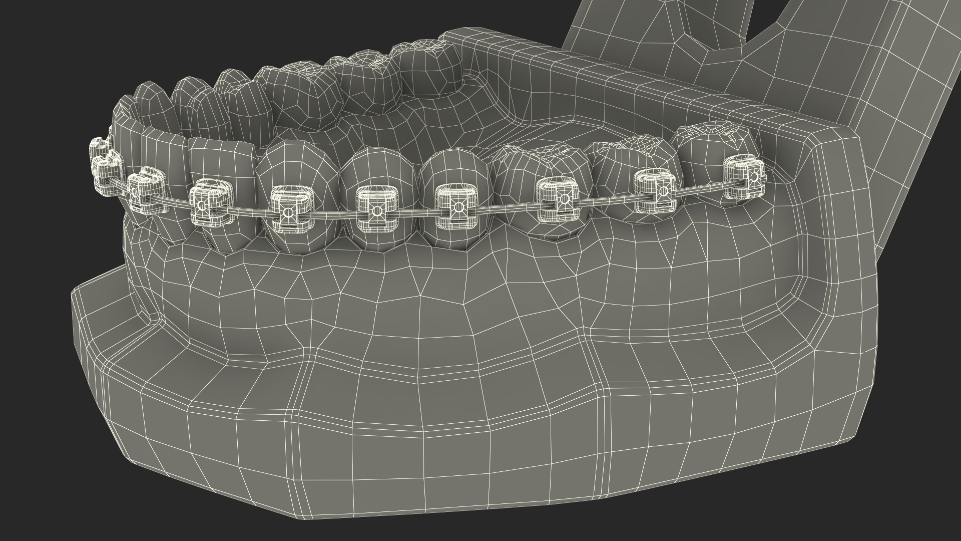 3D Ligature-Free Braces on Artificial Jaw model