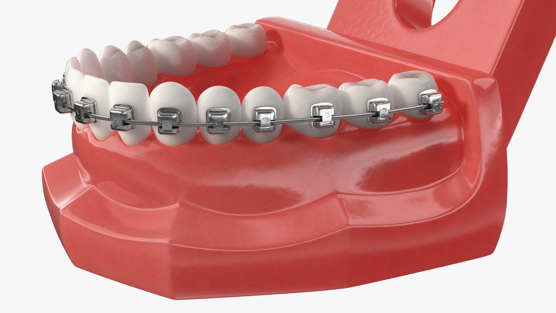 3D Ligature-Free Braces on Artificial Jaw model