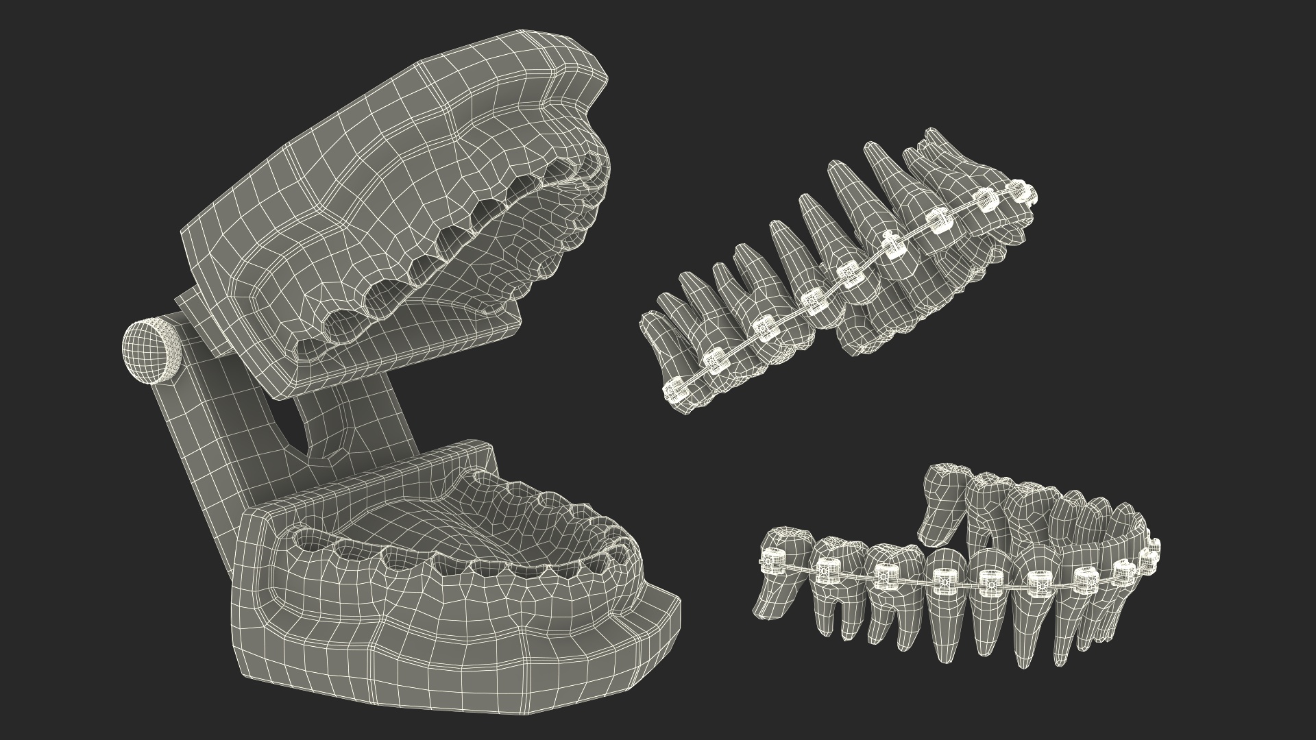 3D Ligature-Free Braces on Artificial Jaw model