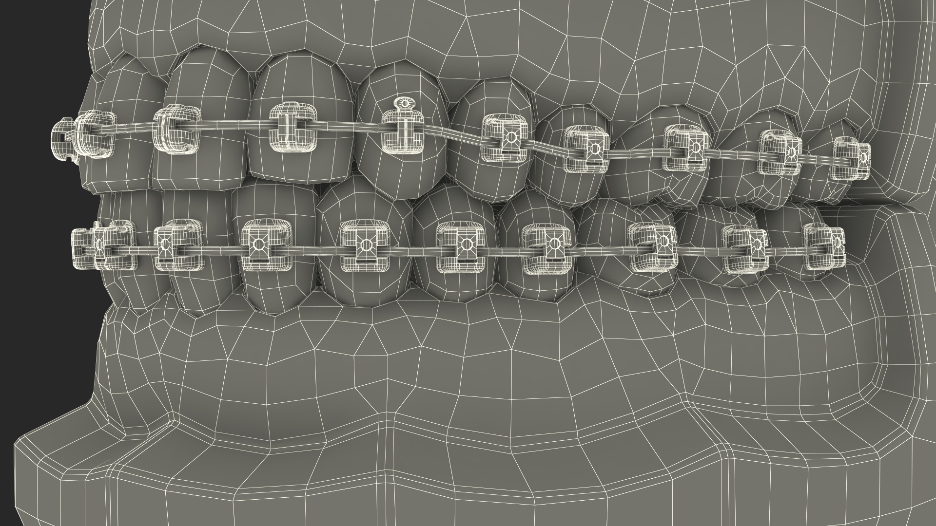 3D Ligature-Free Braces on Artificial Jaw model