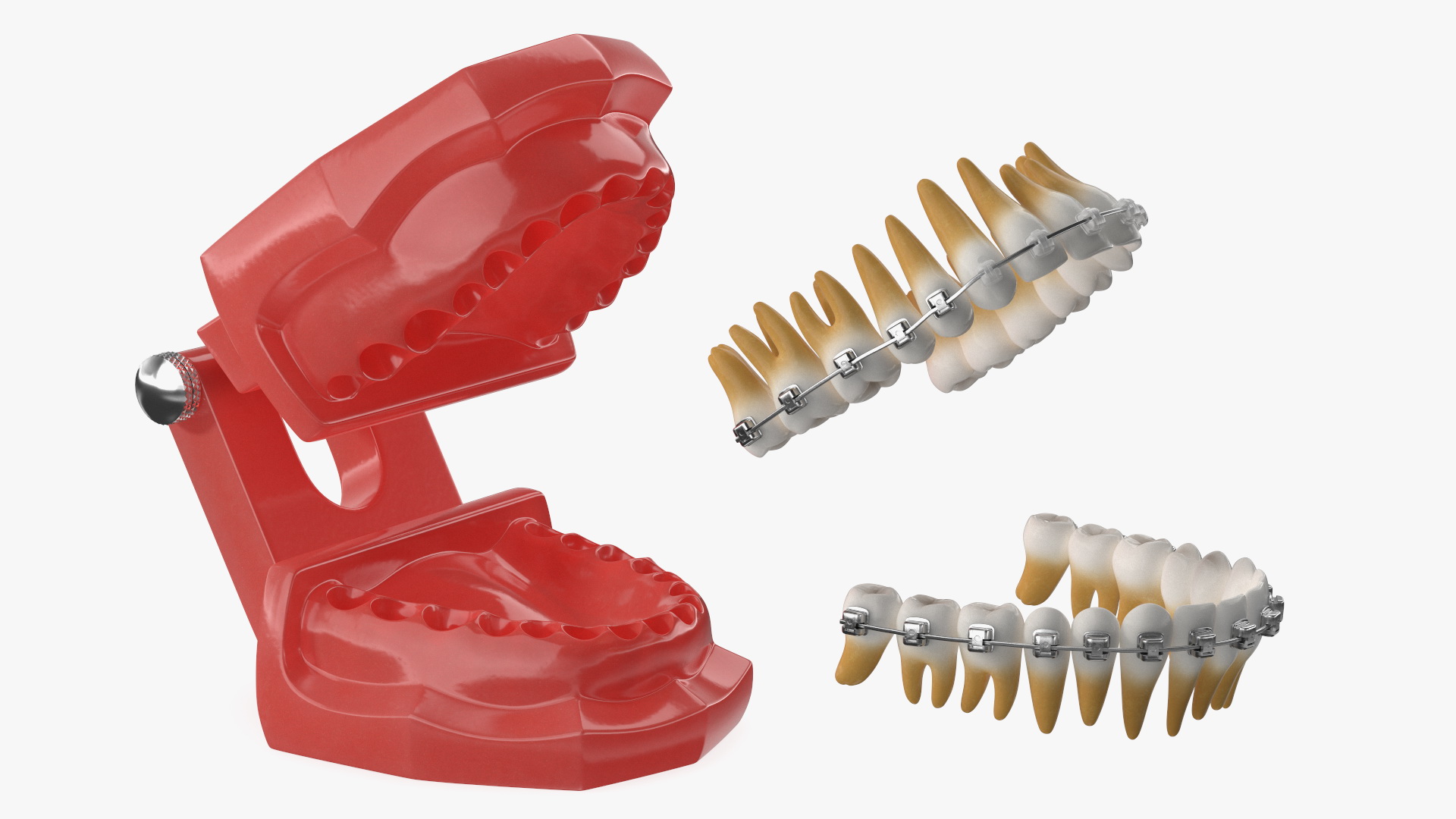 3D Ligature-Free Braces on Artificial Jaw model