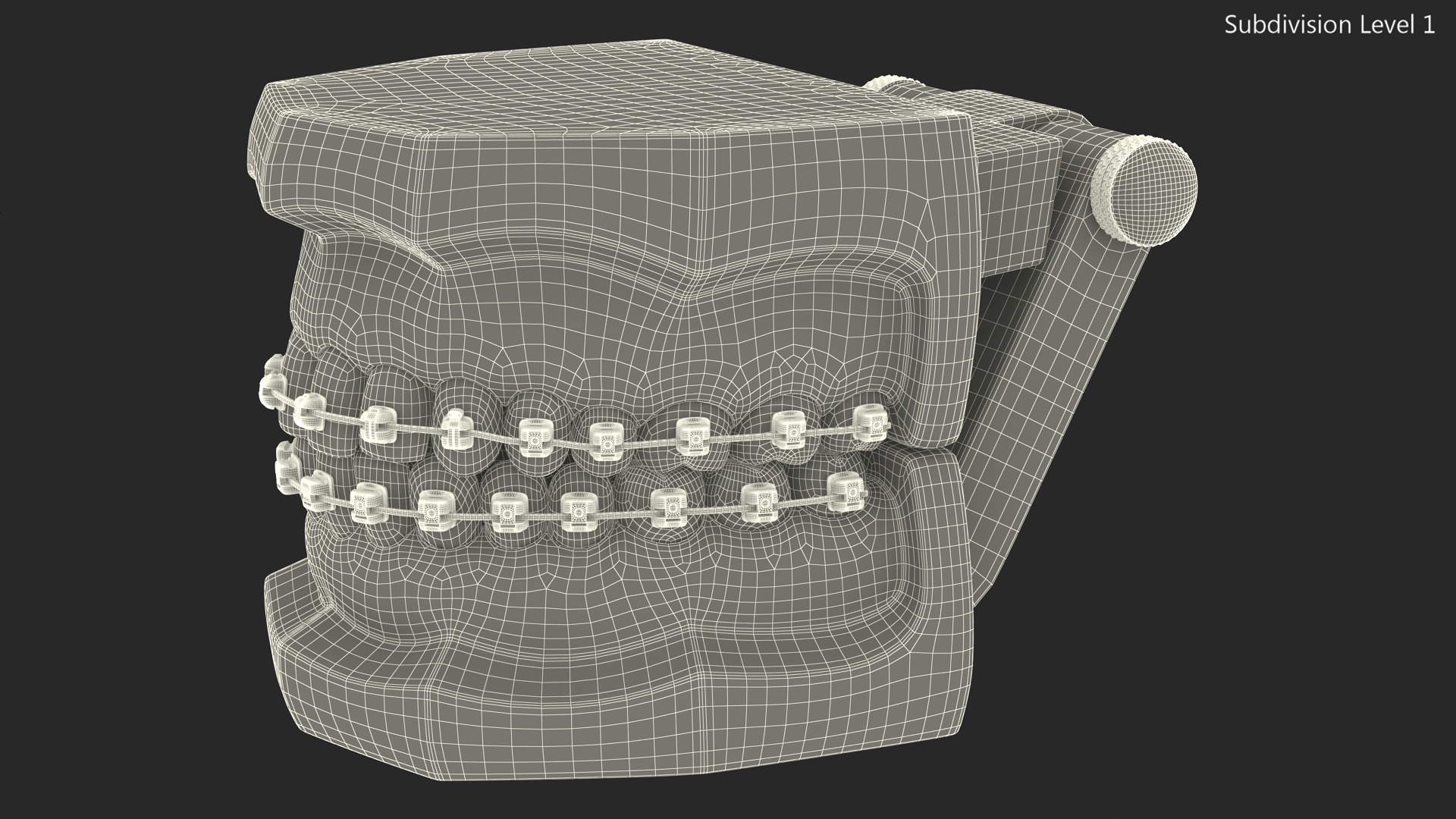 3D Ligature-Free Braces on Artificial Jaw model