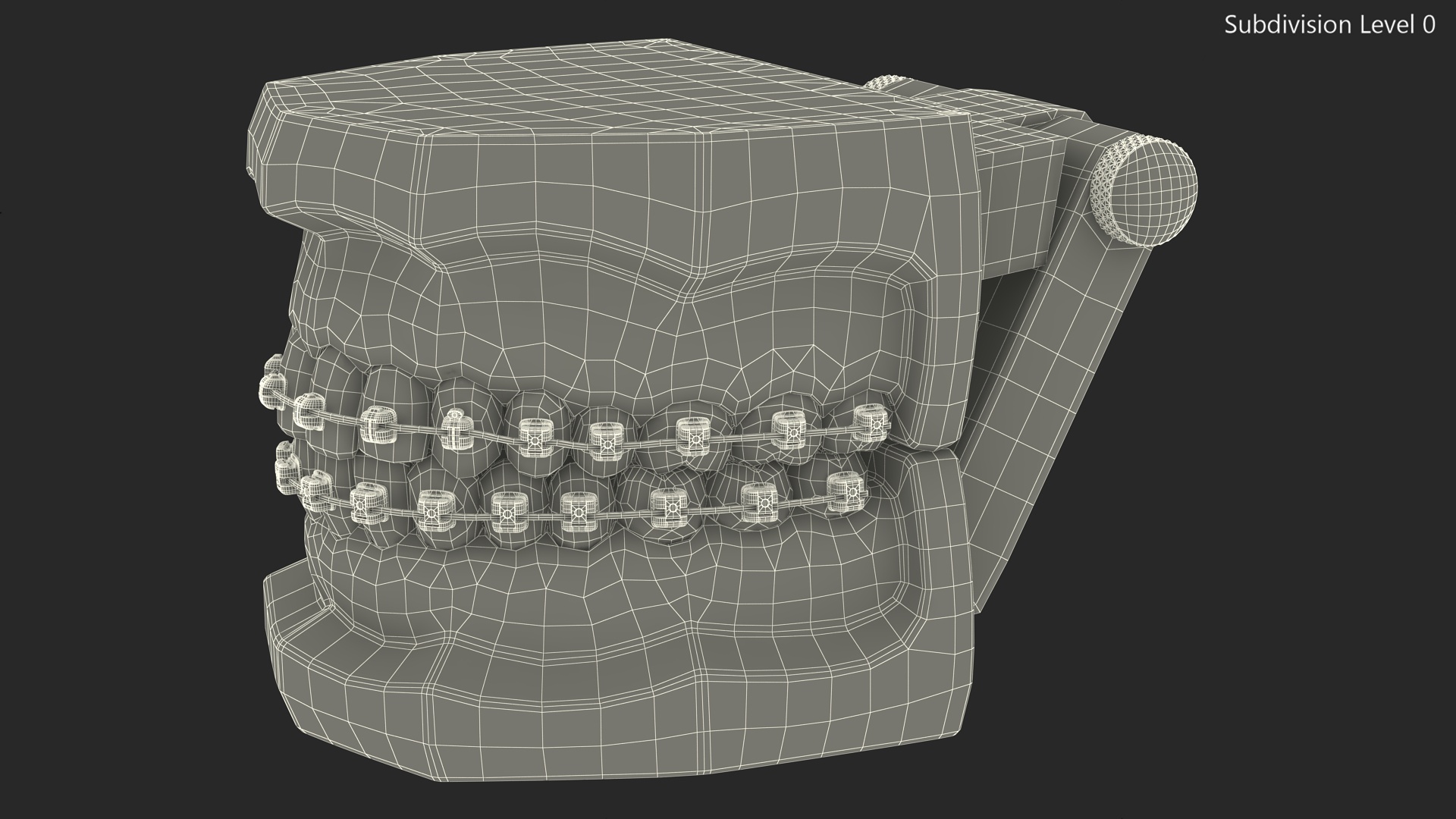 3D Ligature-Free Braces on Artificial Jaw model