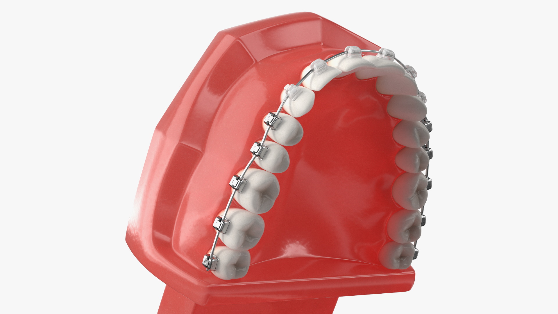 3D Ligature-Free Braces on Artificial Jaw model