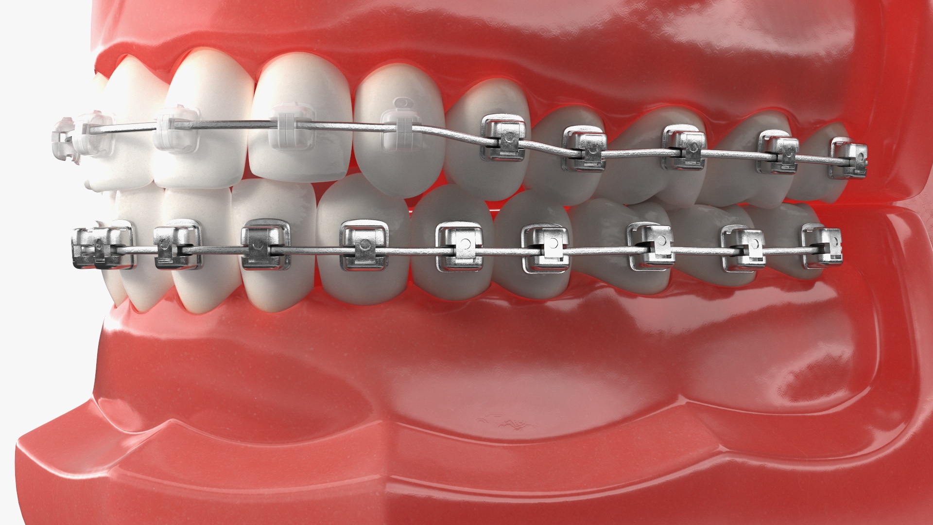 3D Ligature-Free Braces on Artificial Jaw model