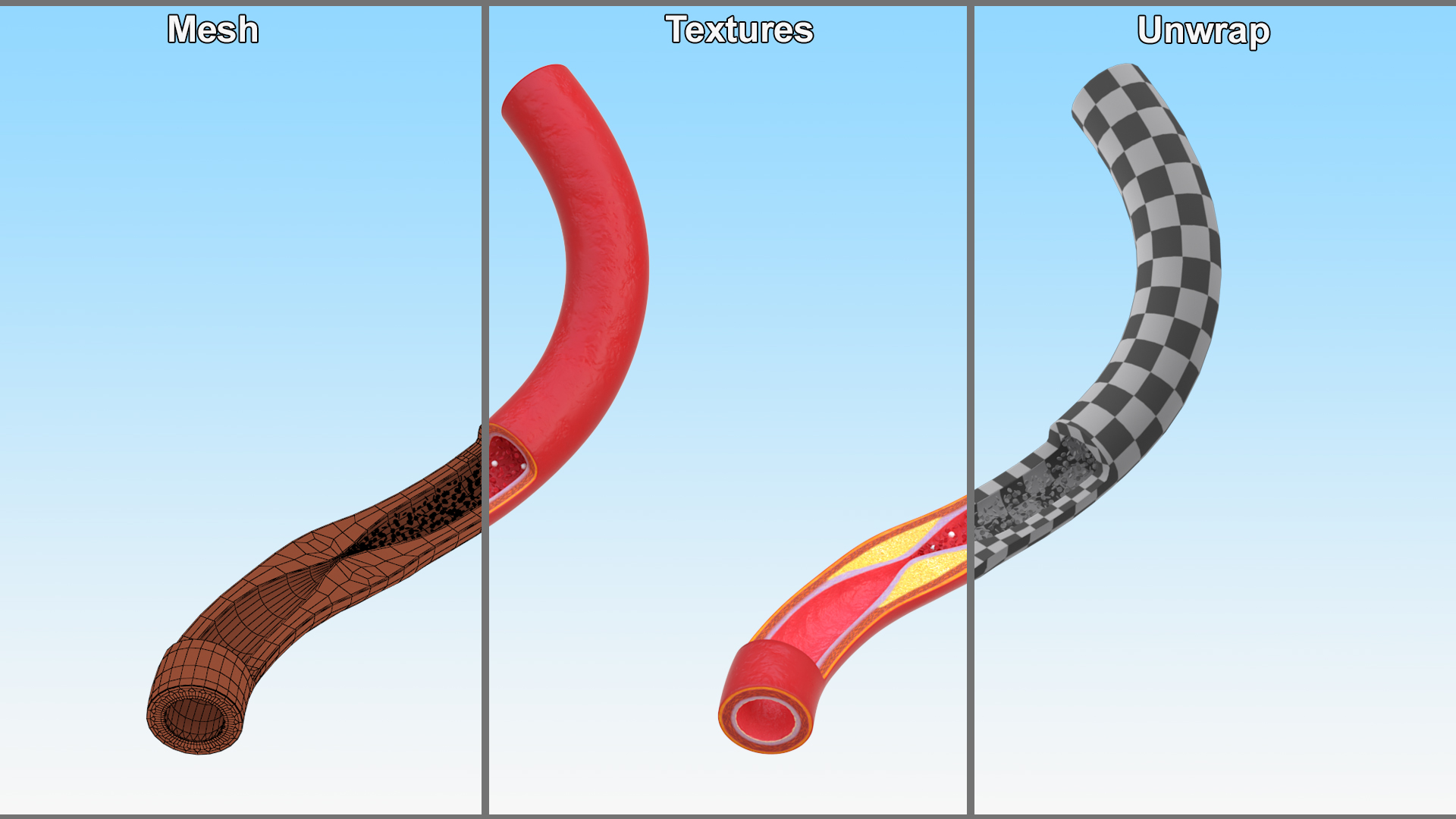 3D Cholesterol Blocked Artery in Cross Section model