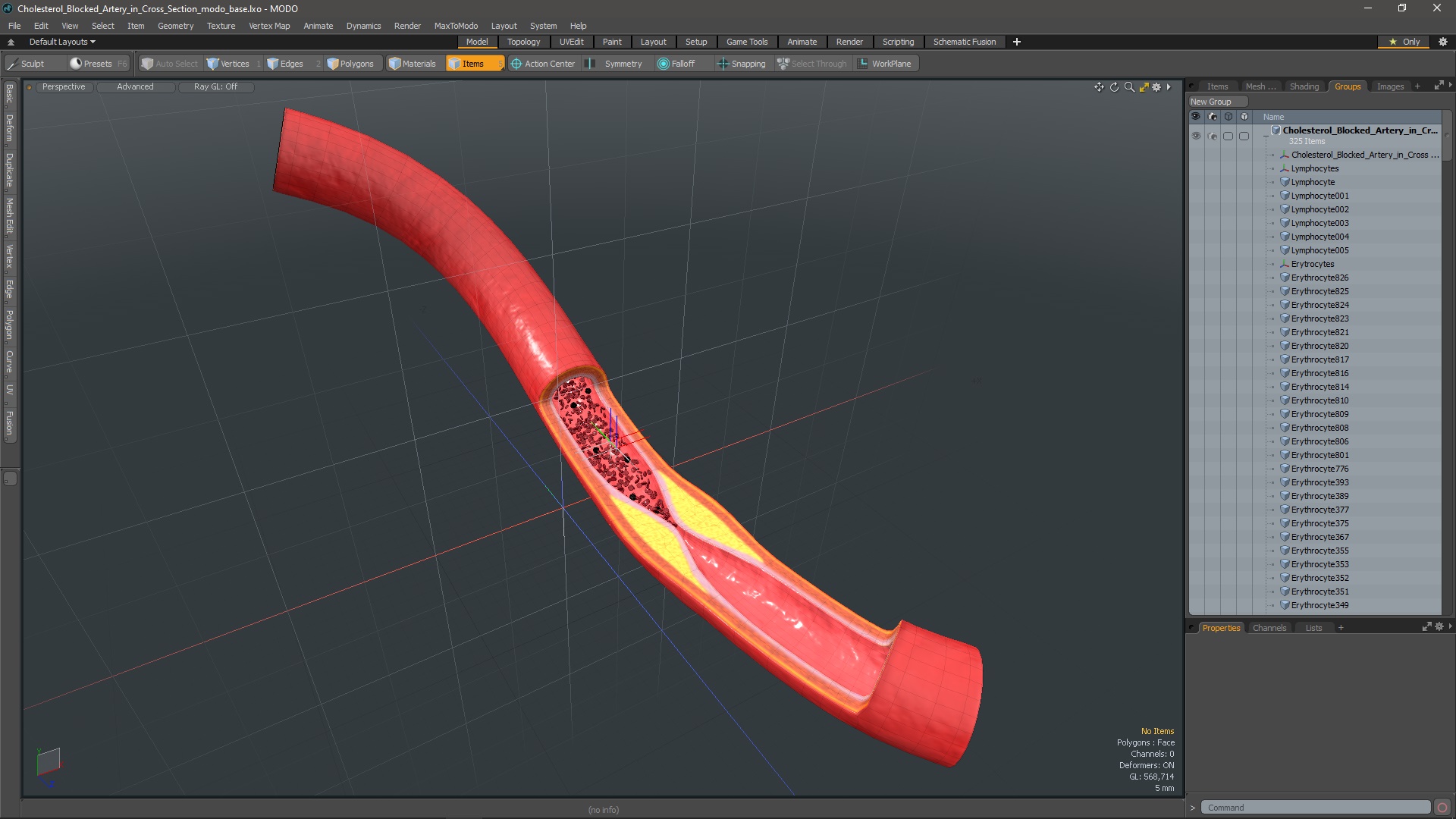 3D Cholesterol Blocked Artery in Cross Section model