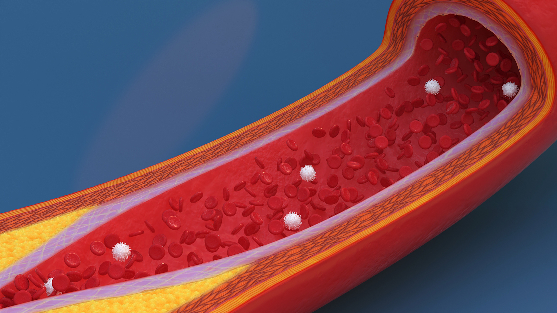 3D Cholesterol Blocked Artery in Cross Section model