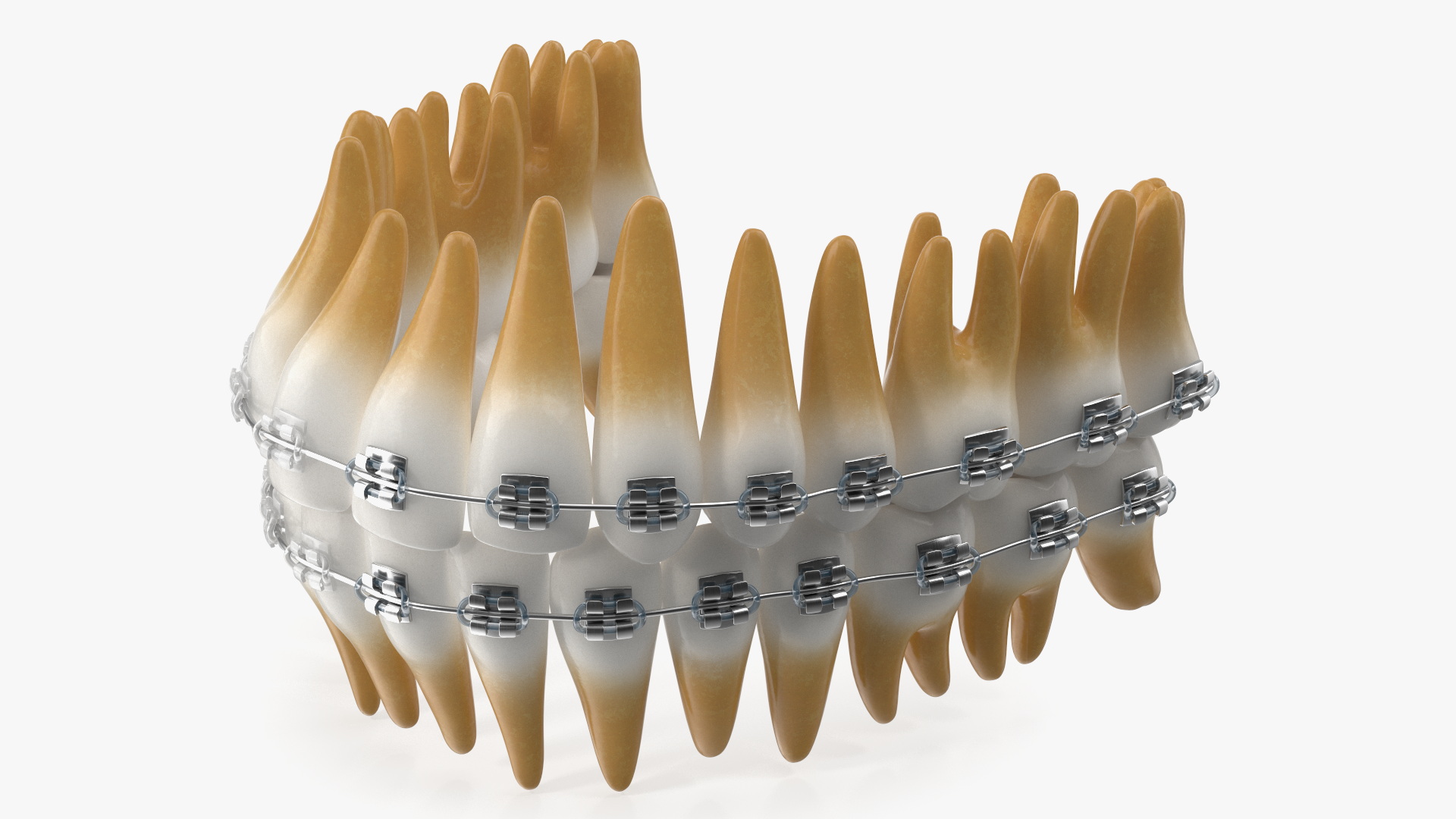 3D model Ligature Braces on Artificial Teeth