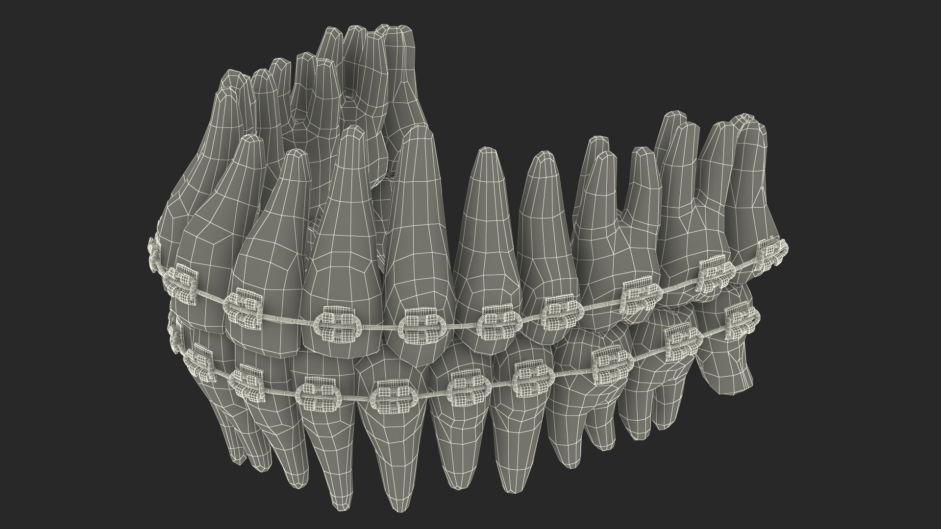 3D model Ligature Braces on Artificial Teeth