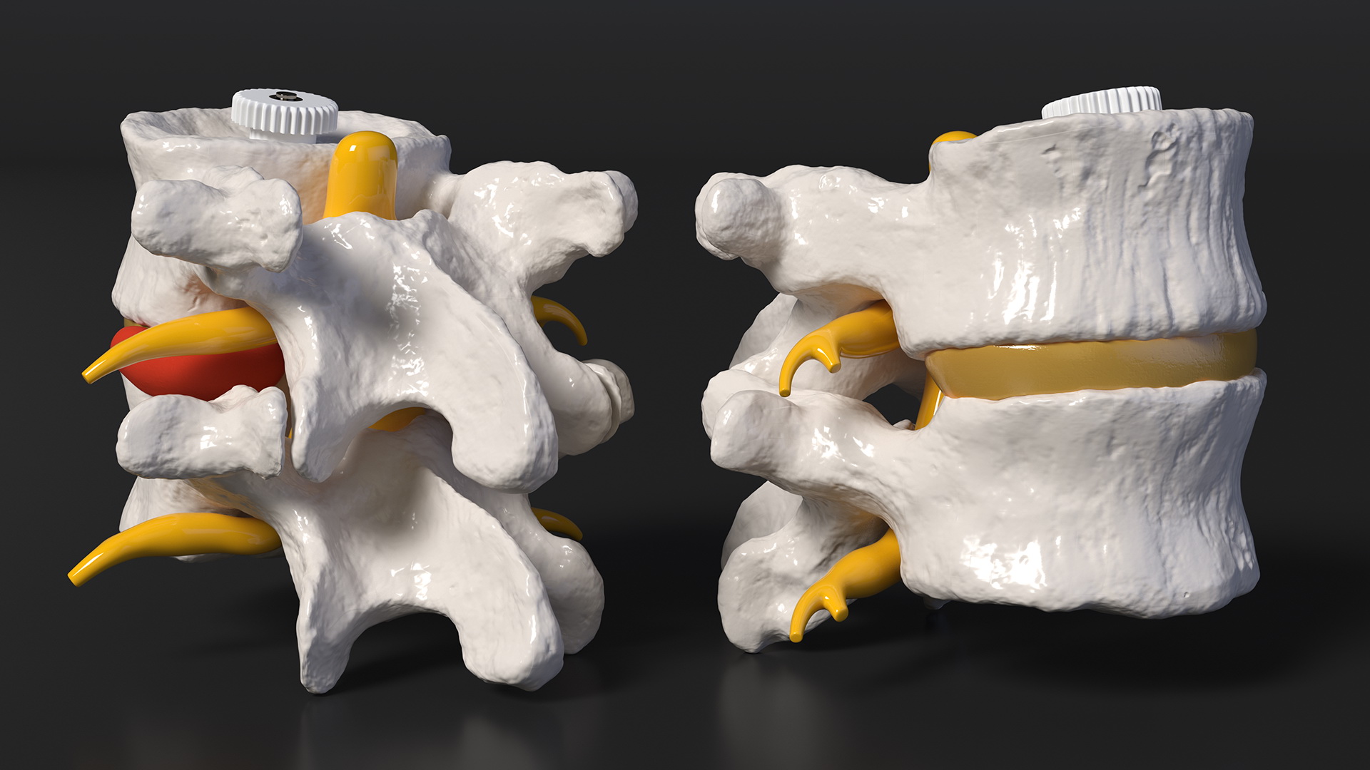 3D Part of Spinal Column with Hernia model