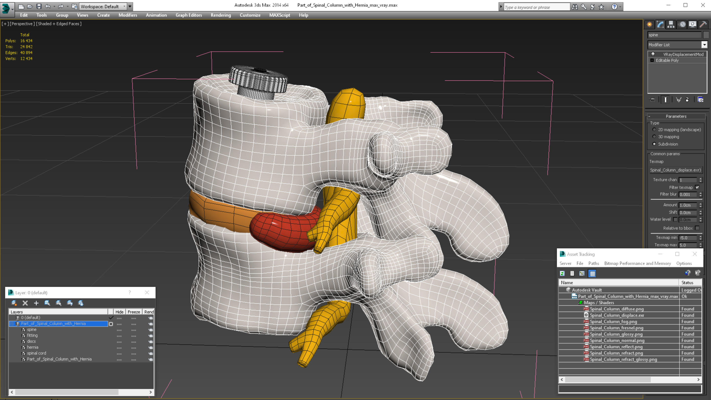 3D Part of Spinal Column with Hernia model