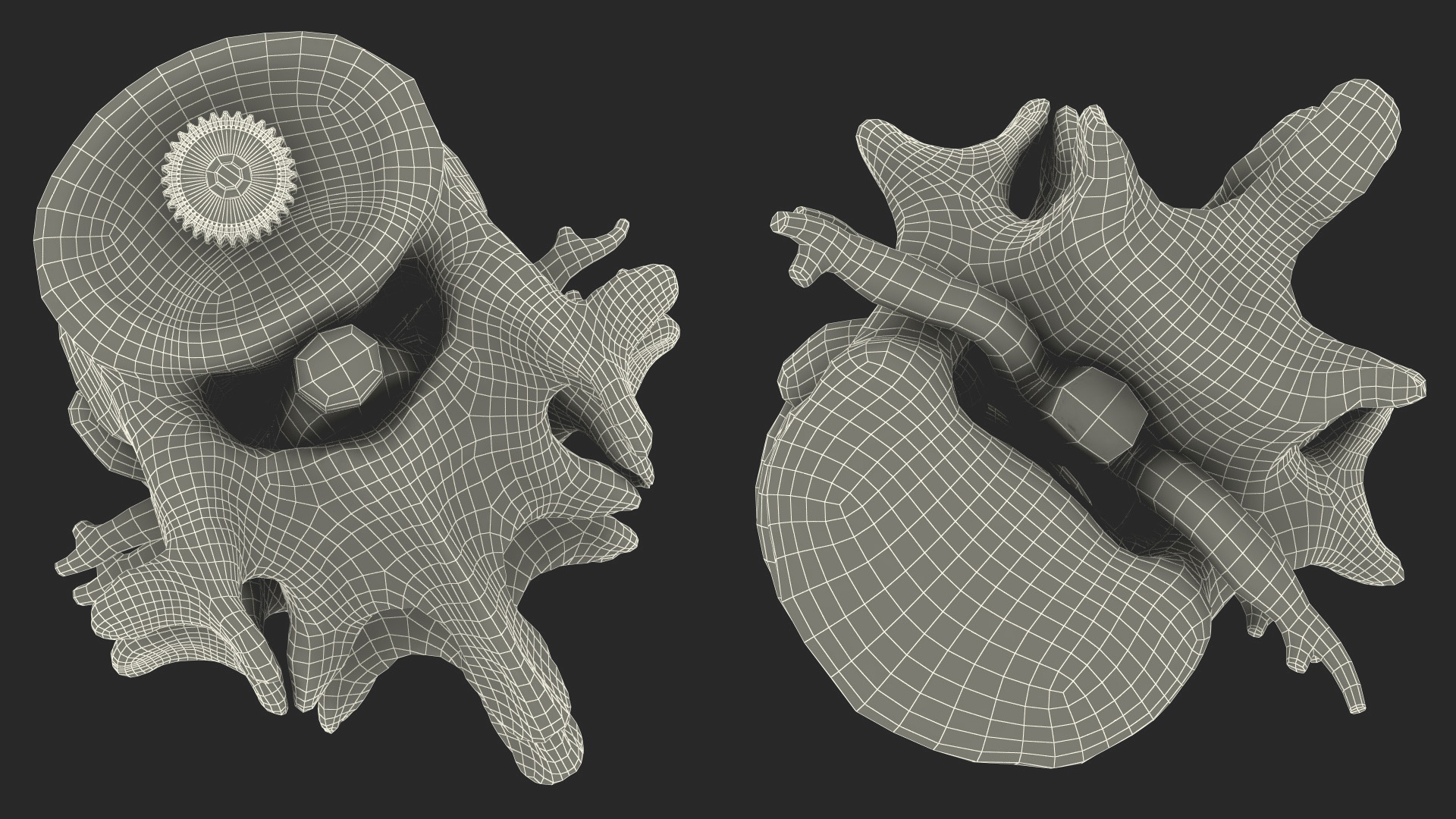 3D Part of Spinal Column with Hernia model