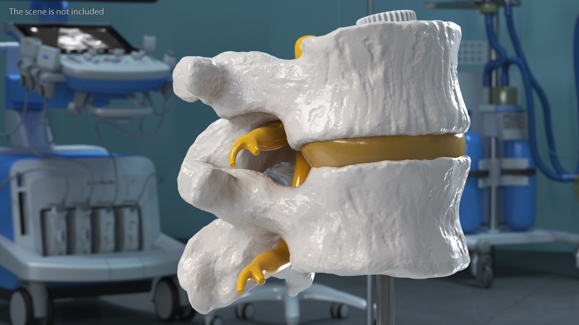 3D Part of Spinal Column with Hernia model