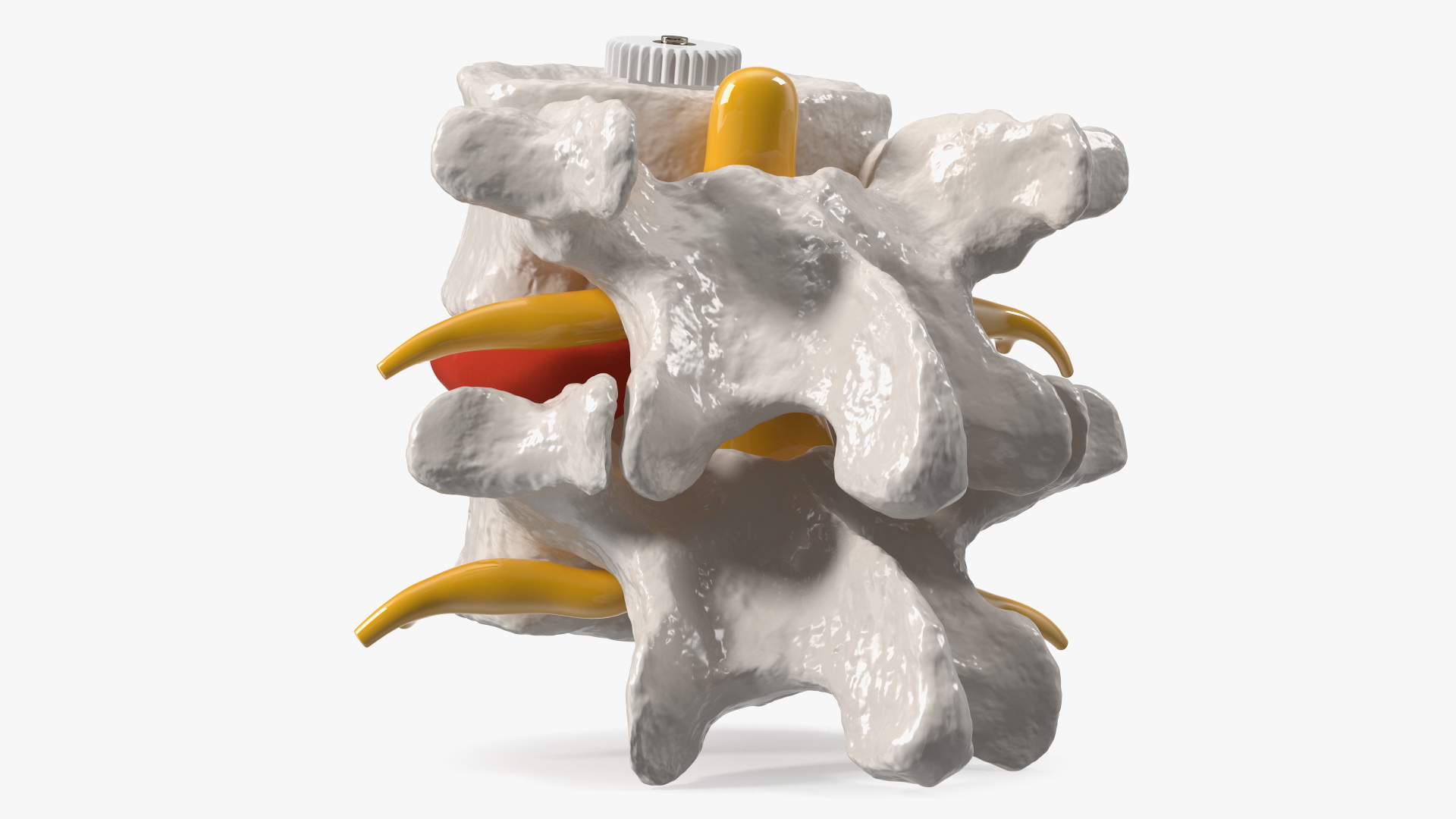 3D Part of Spinal Column with Hernia model