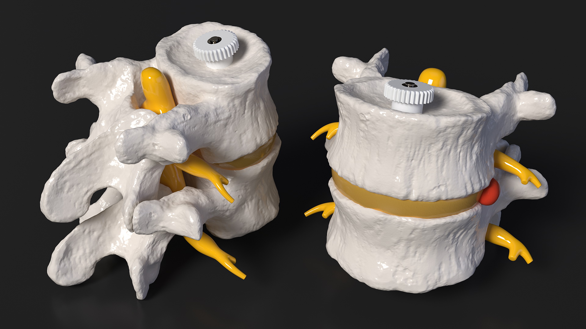 3D Part of Spinal Column with Hernia model