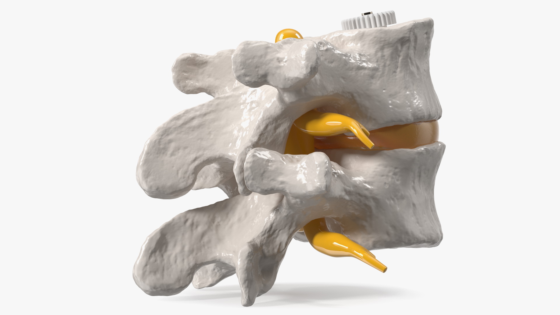 3D Part of Spinal Column with Hernia model