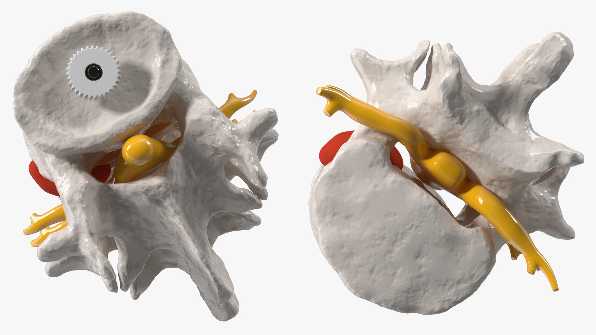 3D Part of Spinal Column with Hernia model