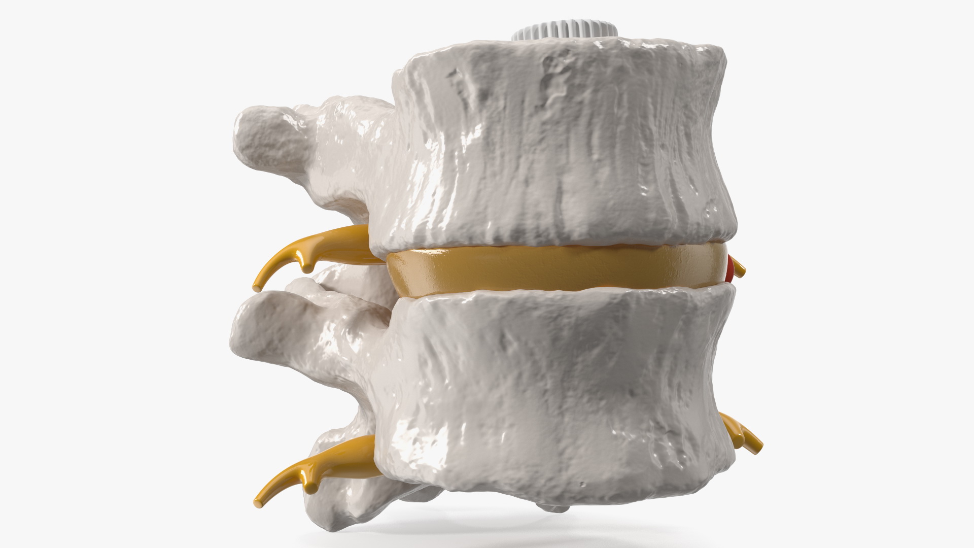 3D Part of Spinal Column with Hernia model