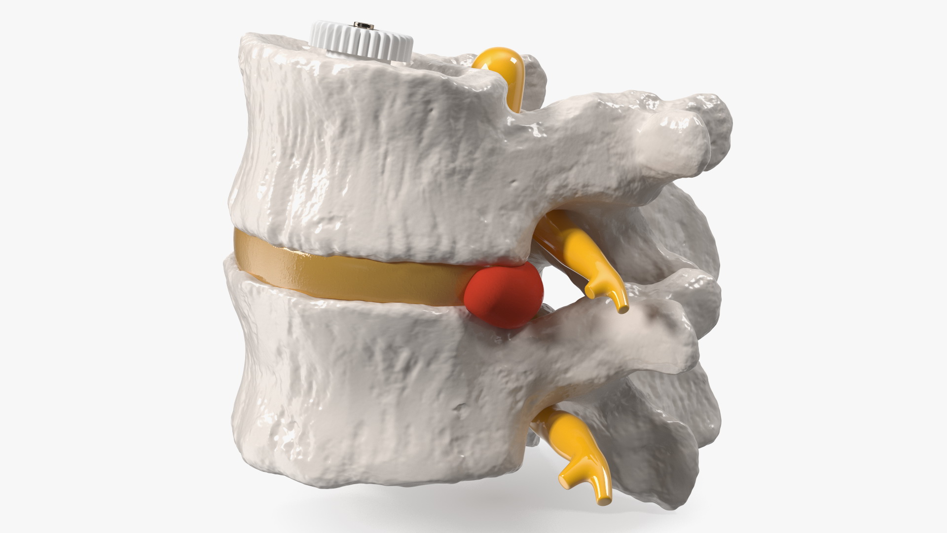 3D Part of Spinal Column with Hernia model