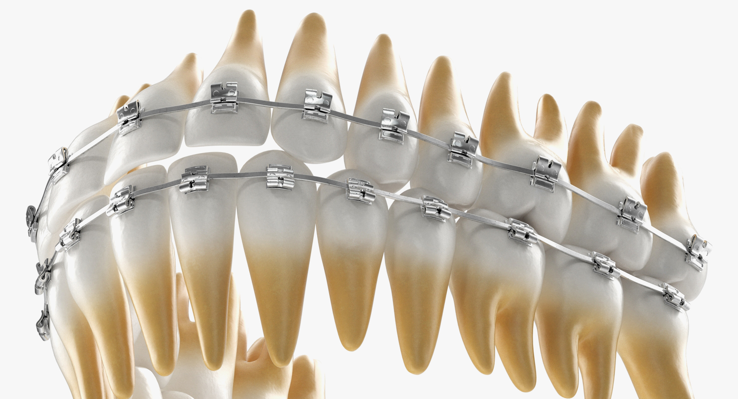 3D Teeth with Braces Model model