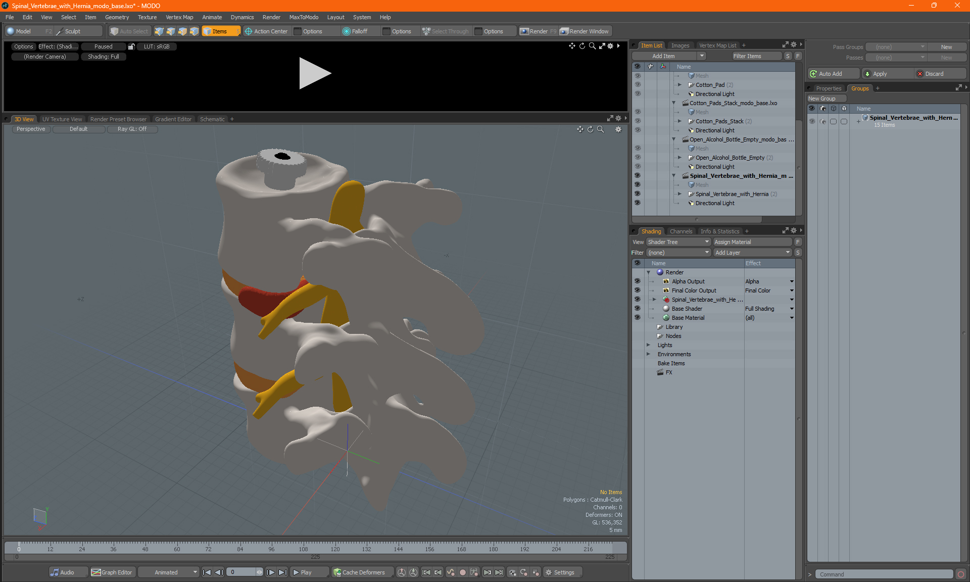 3D Spinal Vertebrae with Hernia model