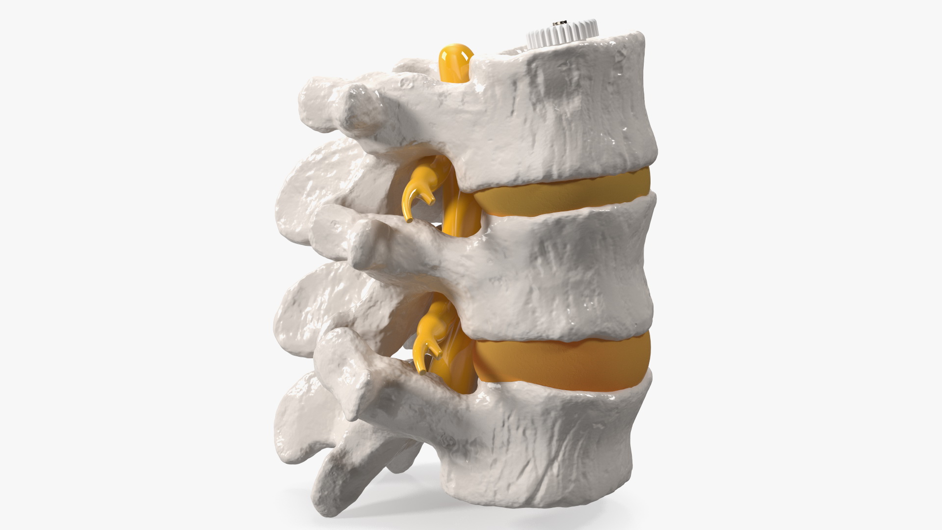 3D Spinal Vertebrae with Hernia model