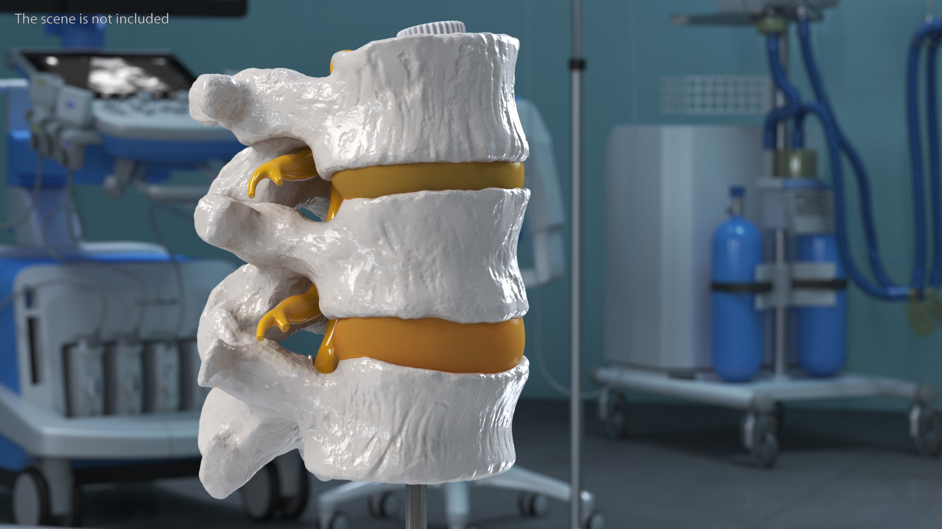 3D Spinal Vertebrae with Hernia model