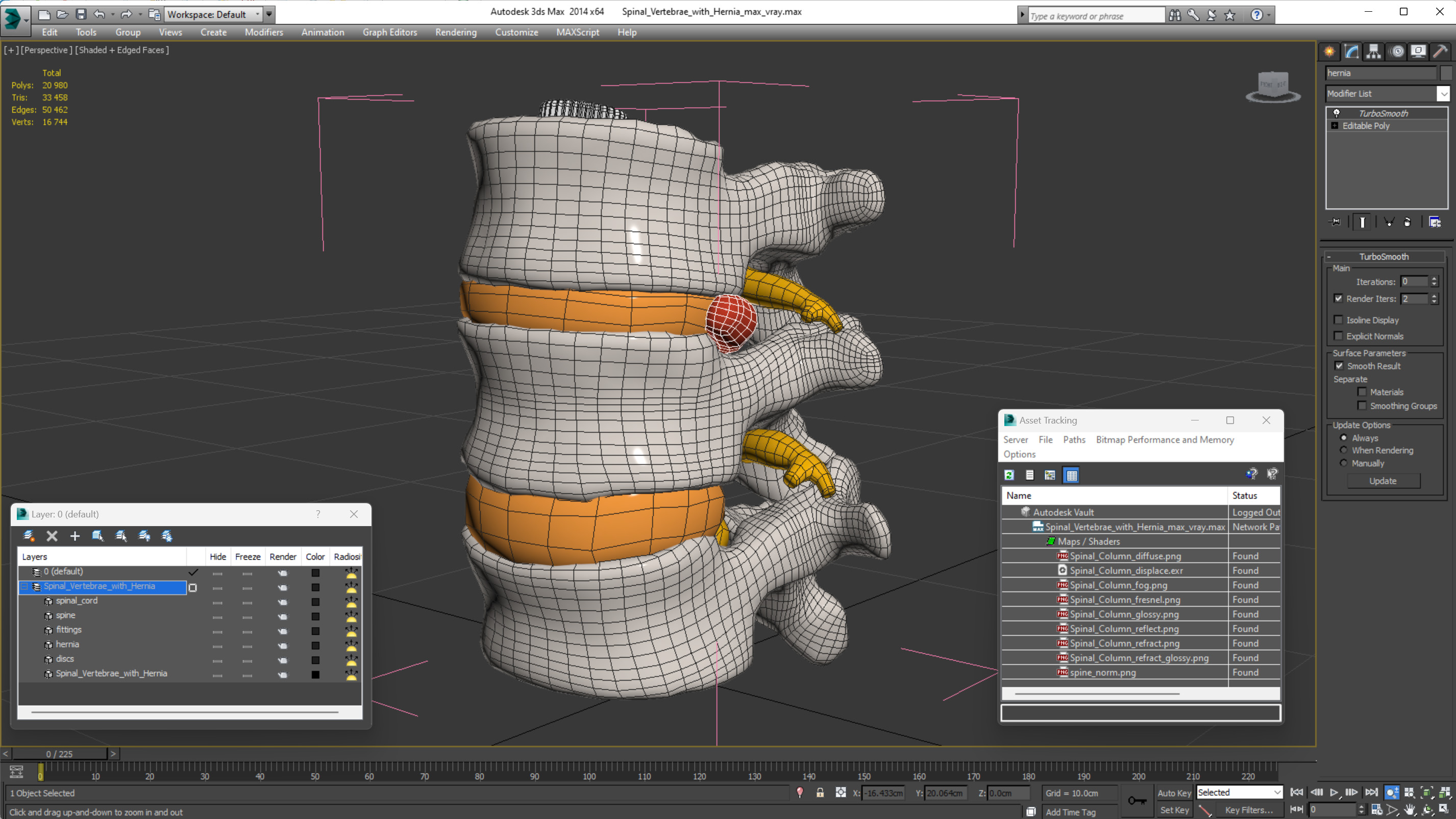 3D Spinal Vertebrae with Hernia model