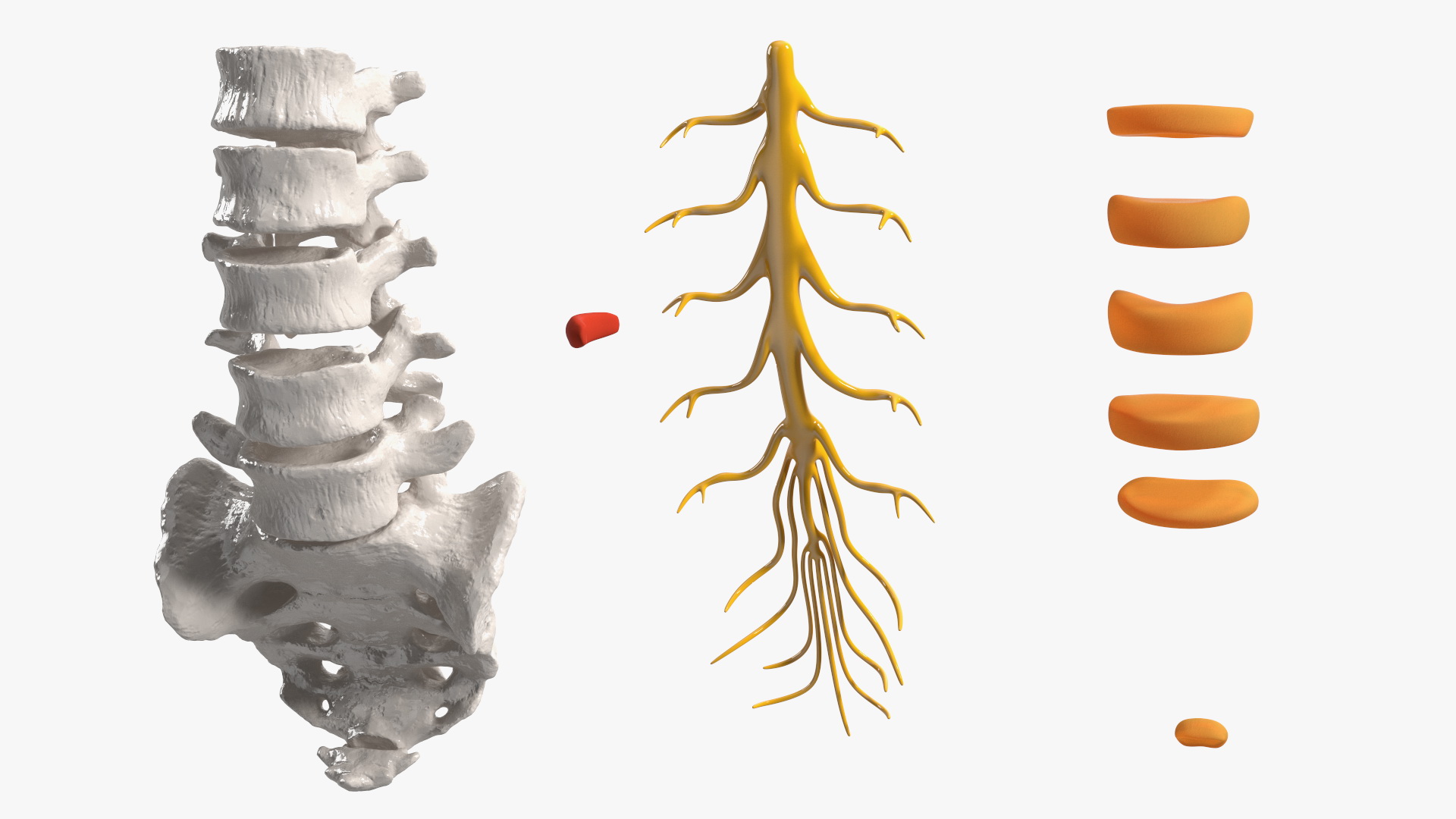 3D model Spinal Column with Hernia