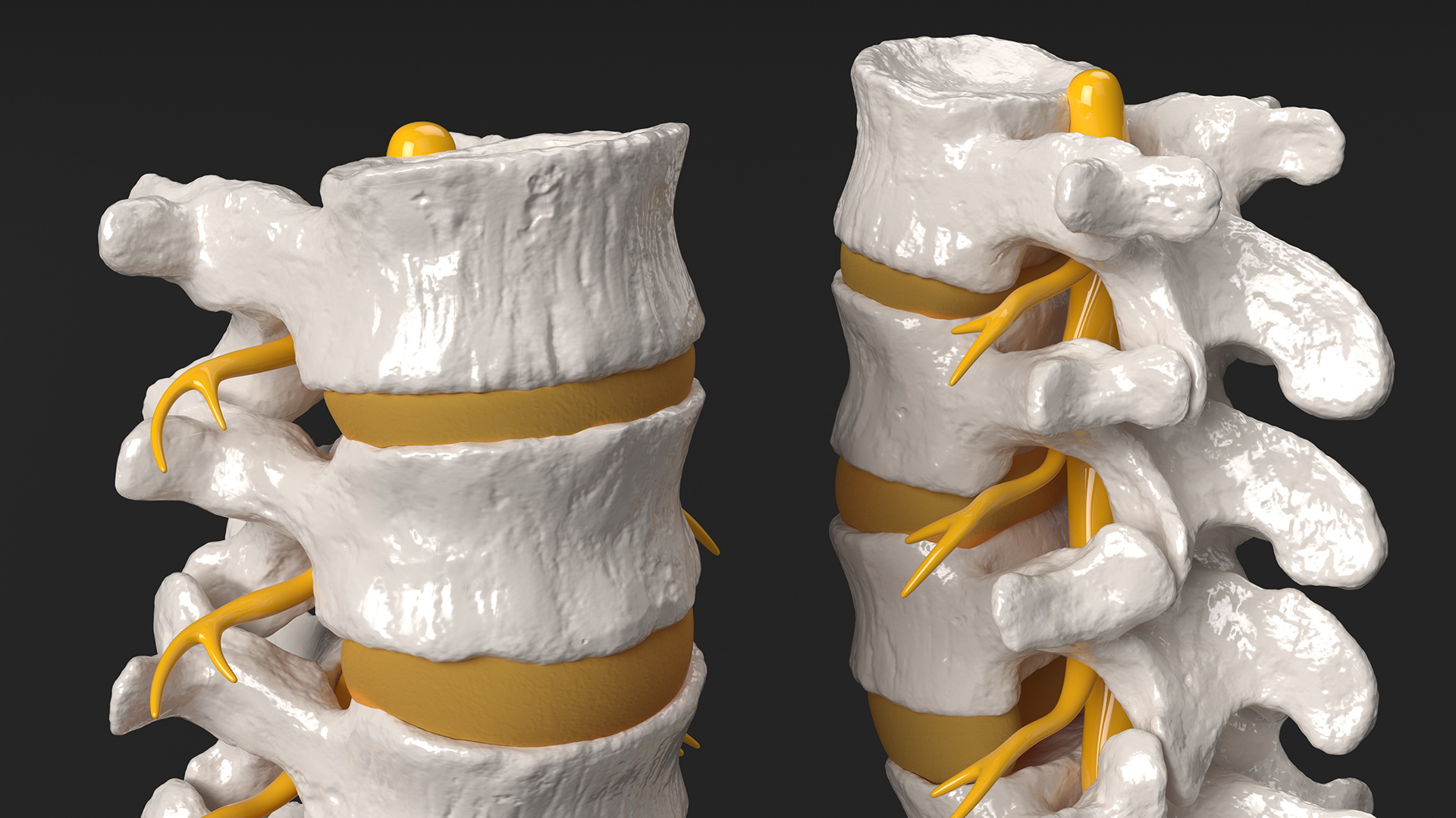 3D model Spinal Column with Hernia