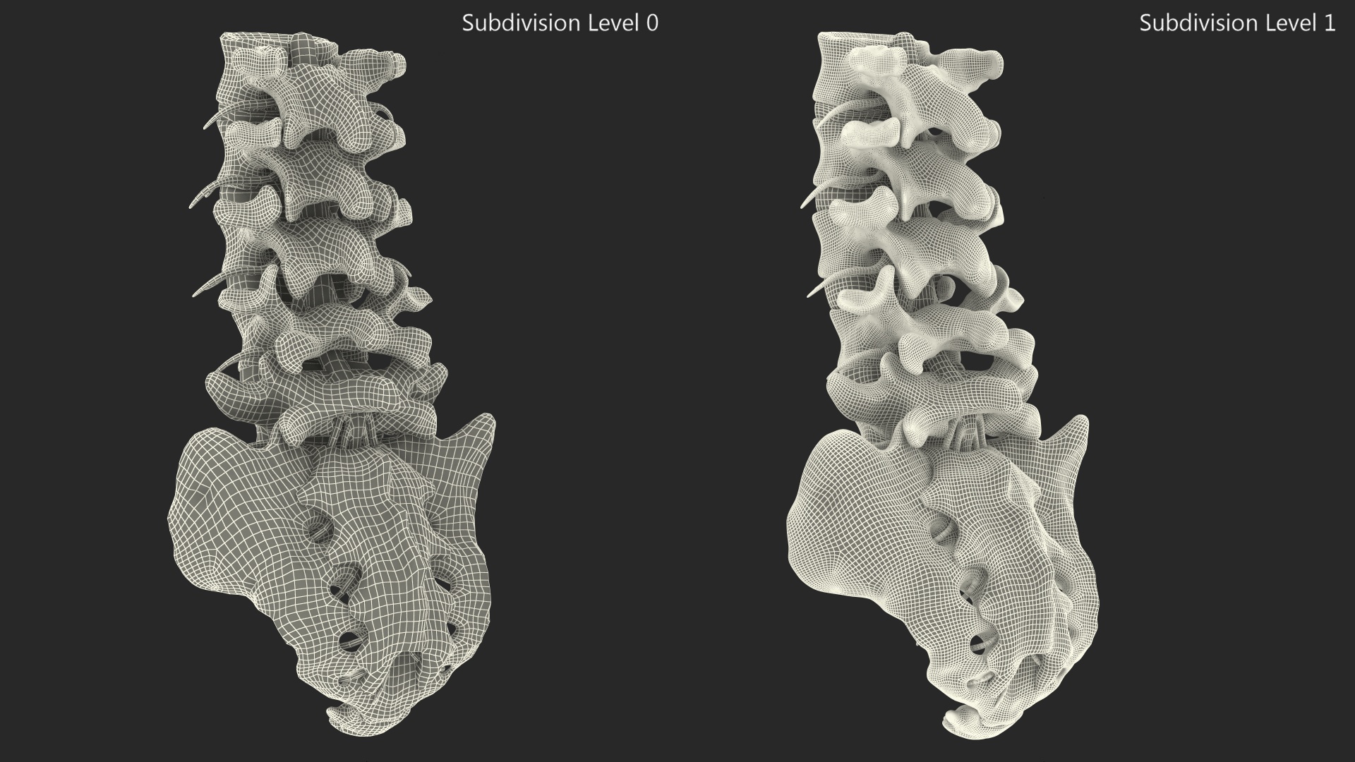 3D model Spinal Column with Hernia