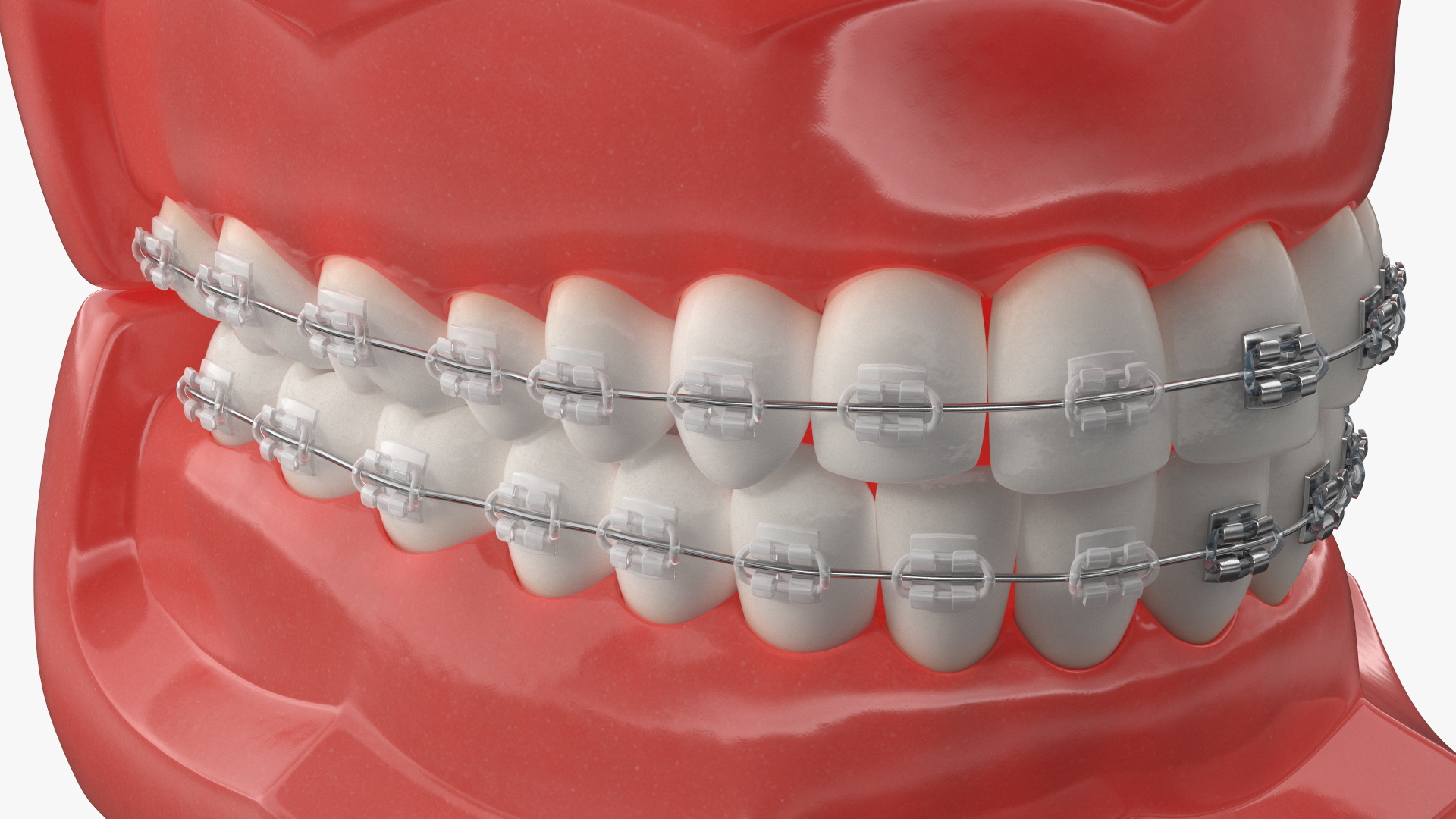 3D model Ligature Braces on Teeth Model