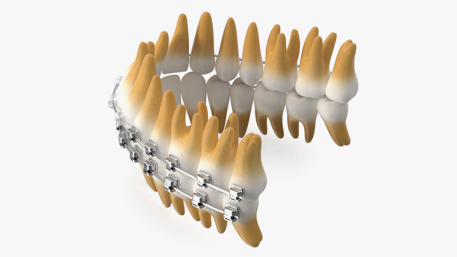 Ligature-Free Braces on Plastic Teeth 3D