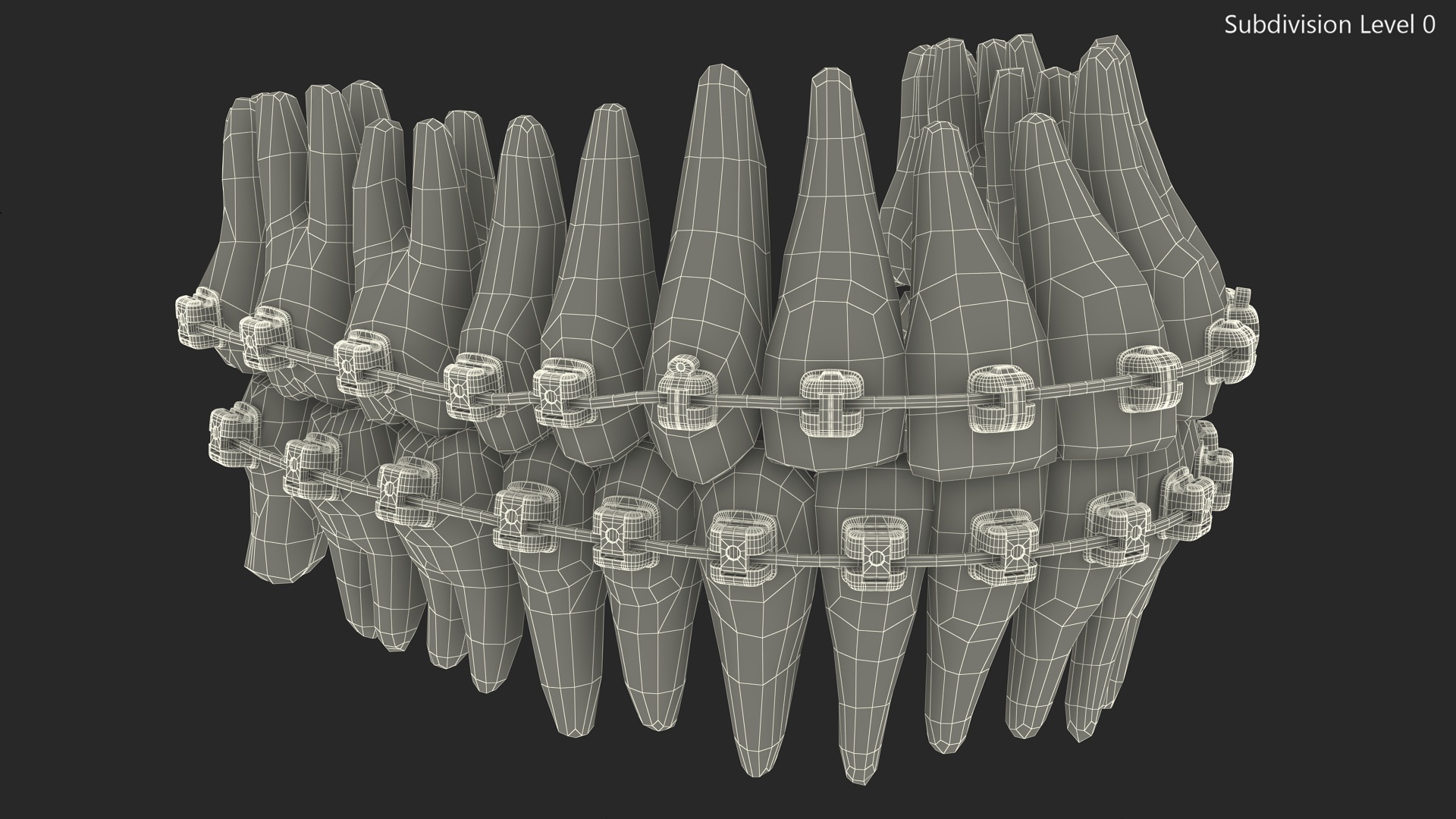 Ligature-Free Braces on Plastic Teeth 3D