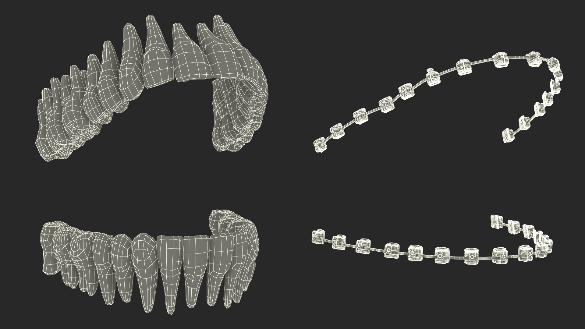 Ligature-Free Braces on Plastic Teeth 3D