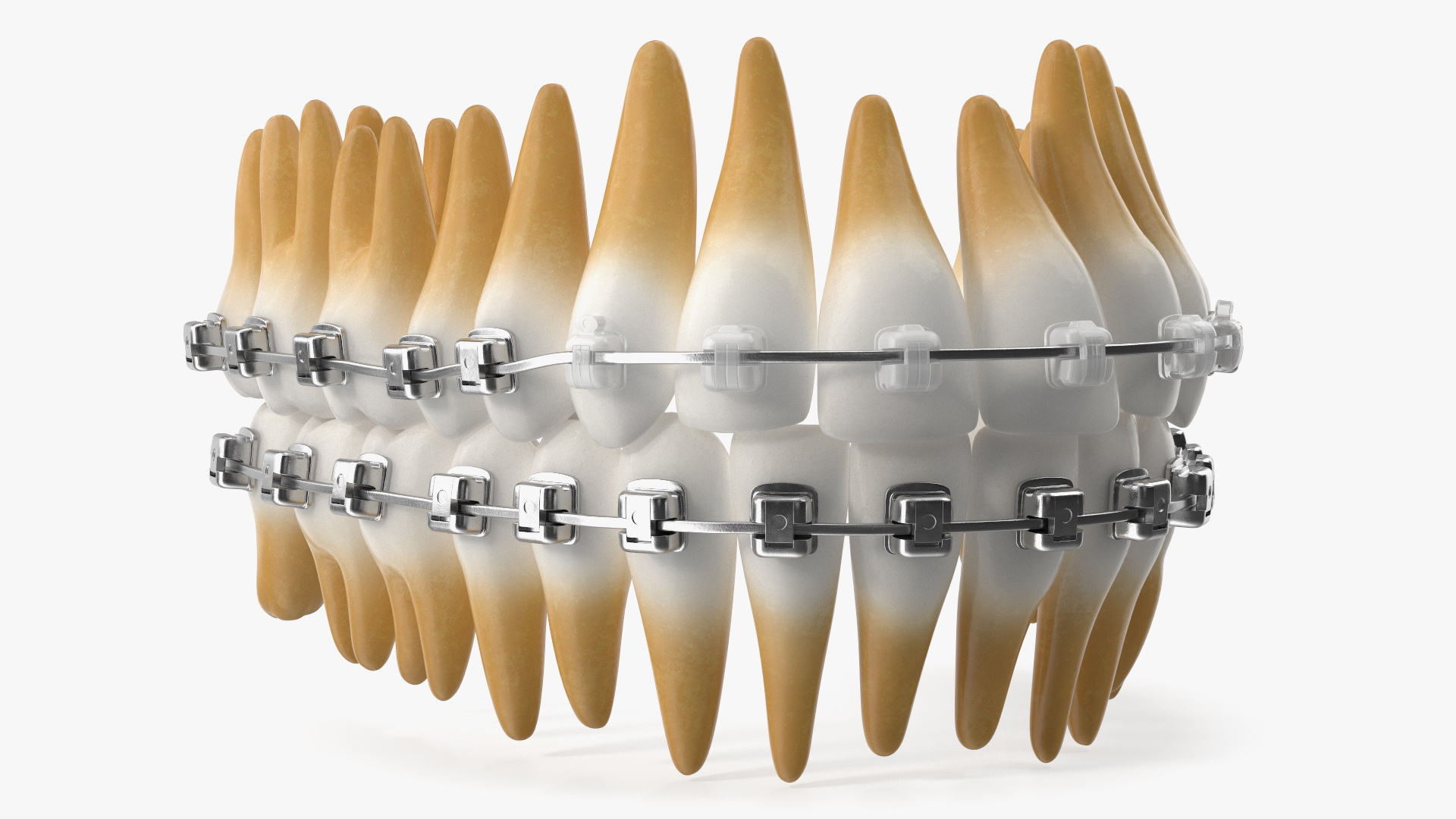 Ligature-Free Braces on Plastic Teeth 3D